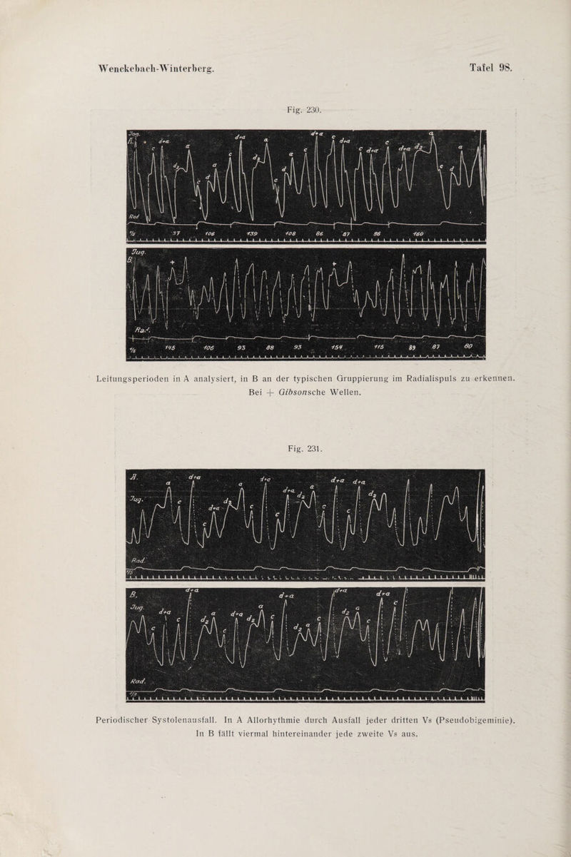 Fig. 230. Leitungsperioden in A analysiert, in B an der typischen Gruppierung im Radialispuls zu erkennen. Bei -f- Gibsonsche Wellen. Fig. 231. Periodischer Systolenausfall. In A Allorhythnrie durch Ausfall jeder dritten Vs (Pseudobigeminie). In B fällt viermal hintereinander jede zweite Vs aus.