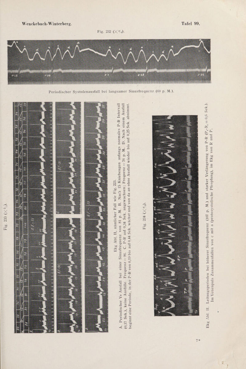 Fig. 232 (X3/4). 11 llli iiil Füll 4 Ui hi iüli Ul i i U 1 fminiflimnmHfifinfffiiiffifiiffiiiiiiHiiiiimiiiiiiHiimminnimiHiiHniiiiiiHifH ivimiiimm nnvnmnmivir Periodischer Systolenausfall bei langsamer Sinnsfrequenz (60 p. M.). *—; dd cd cd > «4-« Vh C/3 <D d* <1 B CU 0) 1 r- cu ’S X <D •G O cd £ z o d X b£ s M—' d 5 CO O- s II b£ N — o> s o n CD CT ’G <d LO . ~ CD C/3 o .G cd CJ z cd £ cd o> b/. s •Q 03 JX D C/3 IO CM «S C/3 5 a> i 15 o. <D CO ■»—< 00 Tf CO^ Ö cT o ;> <4-' N cd' S CU i G CT 0h <D J—i O C/3 2 co , *~*| 03 CO II CD N CD G CT 11-1 CD CD o d Id CD M-H x :cd < X CG < > CD « ( CD • — r*t <D O X -c o d <D 5 CO Cu < o C cö cö G C 3 C/3 33 O :cc3 CU C/3 'Cf ■> K i 0- cu T3 4> •o o 7* J Ekg Abi. II. Leitungsperioden bei höherer Sinusfrequenz (107 p. M.) und starker Verlängerung von P-R (P4-Ra — 0,6 Sek.). Im Venenpuls Zusammenfallen von c mit a (protosystolische Pfropfung), im Ekg von R und P.