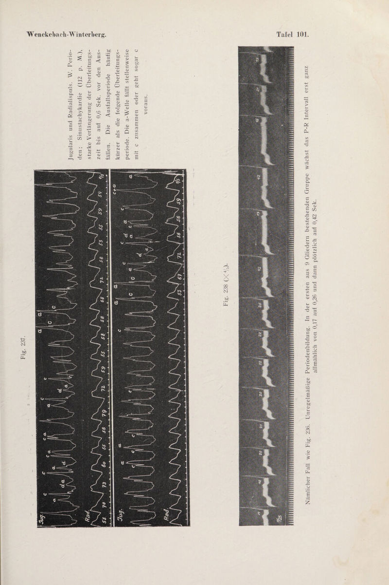 Jugularis und Radialispuls. W. Perio¬ den; Sinustachykardie (1J2 p. M.), starke Verlängerung der Überleitungs- Nämlicher Fall wie Fig. 236. Unregelmäßige Periodenbildung. In der ersten aus 9 Gliedern bestehenden Gruppe wächst das P-R Intervall erst ganz allmählich von 0,17 auf 0,26 und dann plötzlich auf 0,42 Sek.