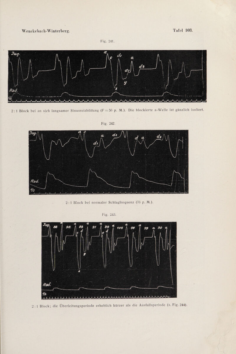 Fig. 241. 2:1 Block bei an sich langsamer Sinusreizbildung (F = 56 p. M.). Die blockierte a-Welle ist gänzlich isoliert. Fig. 242. 2: 1 Block bei normaler Schlagfrequenz (76 p. M.). Fig. 243. 2:1 Block; die Überleitungsperiode erheblich kürzer als die Ausfallsperiode (s. Fig. 244).