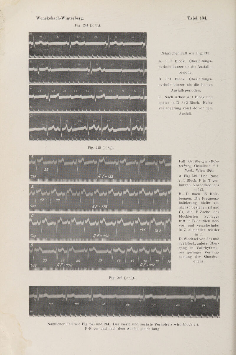 Fig. 244 (X2/3). Flg. 245 (X4/6). Nämlicher Fall wie Fig. 243. A. 2-1 Block. Überleitungs¬ periode kürzer als die Ausfalls¬ periode. B. 3:1 Block. Überleitungs¬ periode kürzer als die beiden Ausfallsperioden. C. Nach Arbeit 4: 1 Block und später in D 3:2 Block. Keine Verlängerung von P-R vor dem Ausfall. Fall Graßberger-Win¬ terberg, Gesellsch. f. i. Med., Wien 1926. A. Ekg Abi. II bei Ruhe. 2 : 1 Block. P in T ver¬ borgen. Vorhoffrequenz = 122. B — D nach 15 Knie¬ beugen. Die Frequenz¬ halbierung bleibt zu¬ nächst bestehen (B und C), die P-Zacke des blockierten Schlages tritt in B deutlich her¬ vor und verschwindet in C allmählich wieder in T. D. Wechsel von 2:1 und 3:2 Block, zuletzt Über¬ gang in Vollrhythmus bei geringer Verlang¬ samung der Sinusfre¬ quenz. Fig. 246 (X4/5)- Nämlicher Fall wie Fig. 243 und 244. Der vierte und sechste Vorhofreiz wird blockiert. P-R vor und nach dem Ausfall gleich lang.