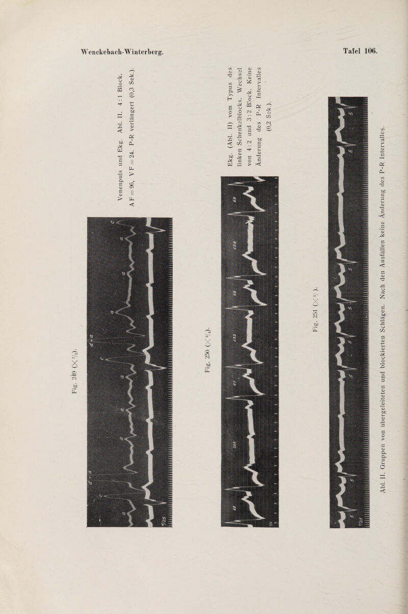 Fig. 249 (X2/3)- Abi. II. Gruppen von übergeleiteten und blockierten Schlägen. Näch den Ausfällen keine Änderung des P-R Intervalles.