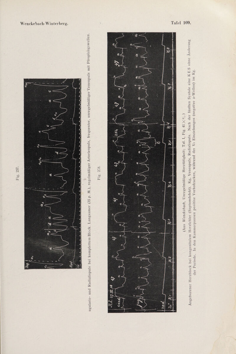 Fig. 257. Wen ck eh a eh - W i n t er k er g, (Aus Wenckebach, Unregelmäßige Herztätigkeit; Taf. I, Fig. 41X3A ) Angeborener Herzblock bei kongenitalem Herzfehler (Septumdefekt). Kg, Venenpuls, Radialispuls. Nach der fünften Systole eine KES ohne Änderung der Periode, In den Kammerpausen positive Vorhofzacken, während dei Vs Einziehungen (negative a-Wellen) im Kg.
