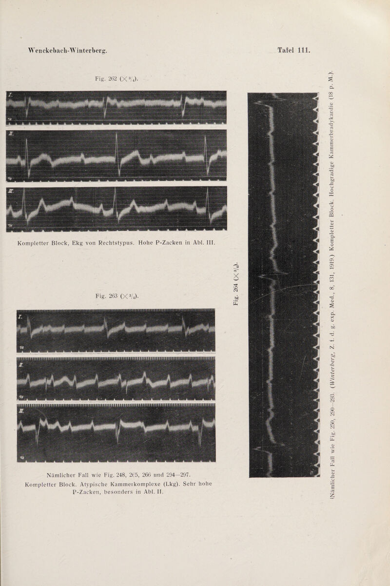 Fig. 262 (X 3A)- Kompletter Block, Ekg von Rechtstypus. Hohe P-Zacken in Abi. III. Nämlicher Fall wie Fig. 248, 265, 266 und 294—297. Kompletter Block. Atypische Kammeikomplexe (Lkg). Sehr hohe P-Zacken, besonders in Abi. II. (Nämlicher Fall wie Fig. 250, 290—293. (Winterberg, Z. i d. g. exp. Med., 8, 131, 1919.) Kompletter Block. Hochgradige Kammerbradykardie (18 p. M.}.