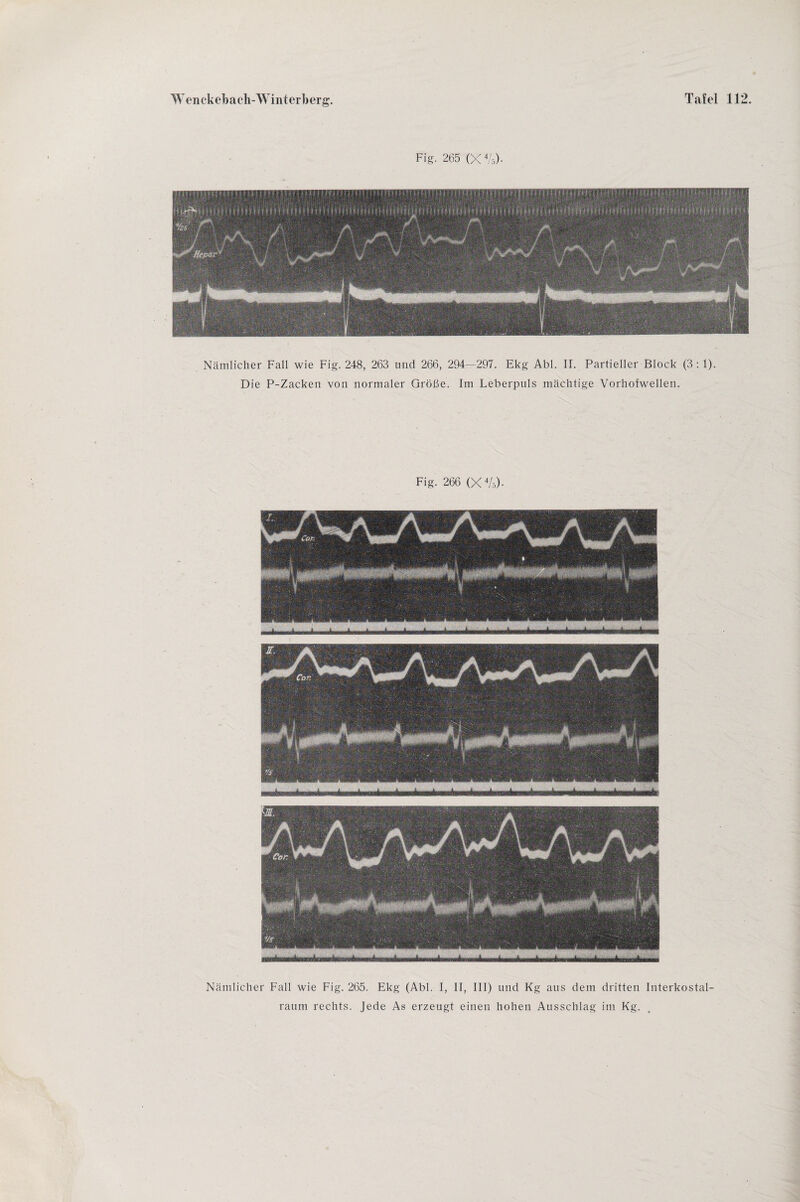 Fig. 265 (X%). Nämlicher Fall wie Fig. 248, 263 und 266, 294—297. Ekg Abi. II. Partieller Block (3 :1). Die P-Zacken von normaler Größe. Im Leberpuls mächtige Vorhofwellen. Fig. 266 (X4/ö). ■ * * - dm ji ii j - - i ■! mm um ■■Mfc—L Nämlicher Fall wie Fig. 265. Ekg (Abi. I, II, III) und Kg aus dem dritten Interkostal¬ raum rechts. Jede As erzeugt einen hohen Ausschlag im Kg.