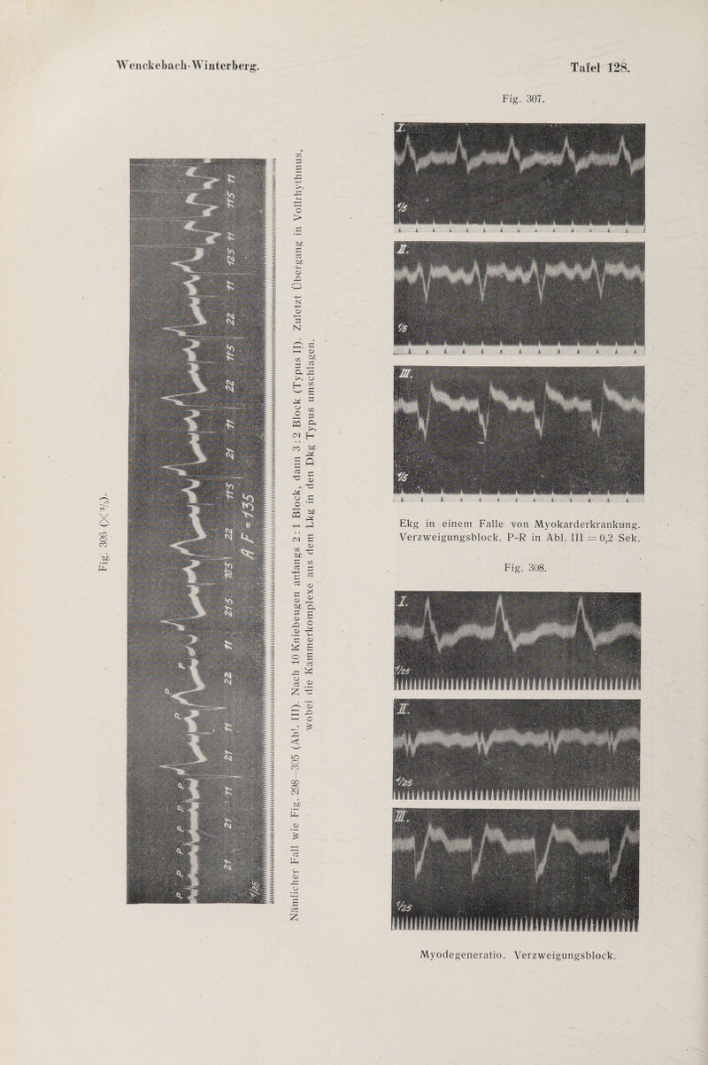 > Vh o -4—* N -4-* N >*—s £ bio T - o H s—' c o o CG a >% CVJ H b/3 ‘v* rh Q 5 r-* C blD b£ G CO G «-+— G G G <D G <D X a> b/0 a, G r- o> r, c O) G S E o £ T“1 G CJ G 53 UP 23 H—< O > . x> < in o CO GO O) CM 'bh Uh O £ G Uh 0) x: o G Ru Z Fig. 307. Fig. 308. Myodegeneratio. Verzweigungsblock