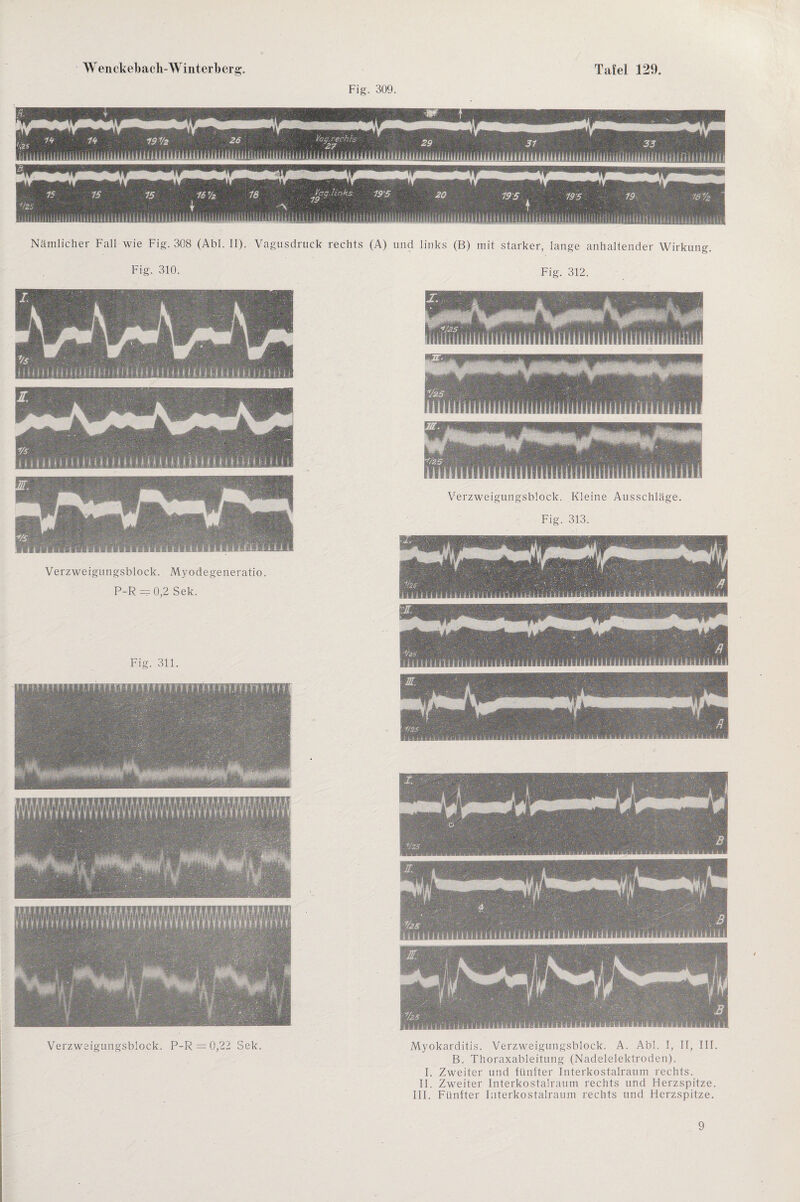 Fig. 309. Nämlicher Fall wie Fig. 308 (Abi. II). Vagusdruck rechts (A) und links (B) mit starker, lange anhaltender Wirkung. Fig. 310. Verzweigungsblock. Myodegeneratio. P-R = 0,2 Sek. Fig. 311. Fig. 312. Verzweigungsblock. Kleine Ausschläge. Fig. 313. Myokarditis. Verzweigungsblock. A. Abi. I, II, III. B. Thoraxableitung (Nadelelektroden). I. Zweiter und fünfter Interkostalraum rechts. II. Zweiter Interkostalraum rechts und Herzspitze. III. Fünfter Interkostalraum rechts und Herzspitze. 9