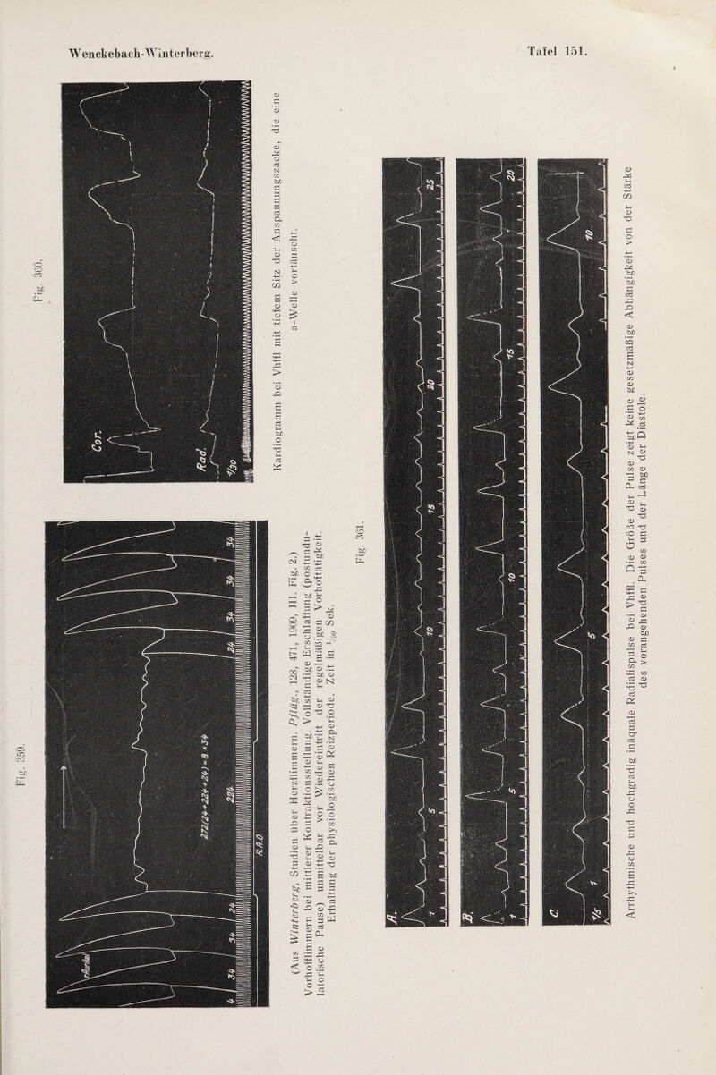 Arrhythmische und hochgradig inäquale Radialispulse bei Vhffl. Die Größe der Pulse zeigt keine gesetzmäßige Abhängigkeit von der Stärke des vorangehenden Pulses und der Länge der Diastole.