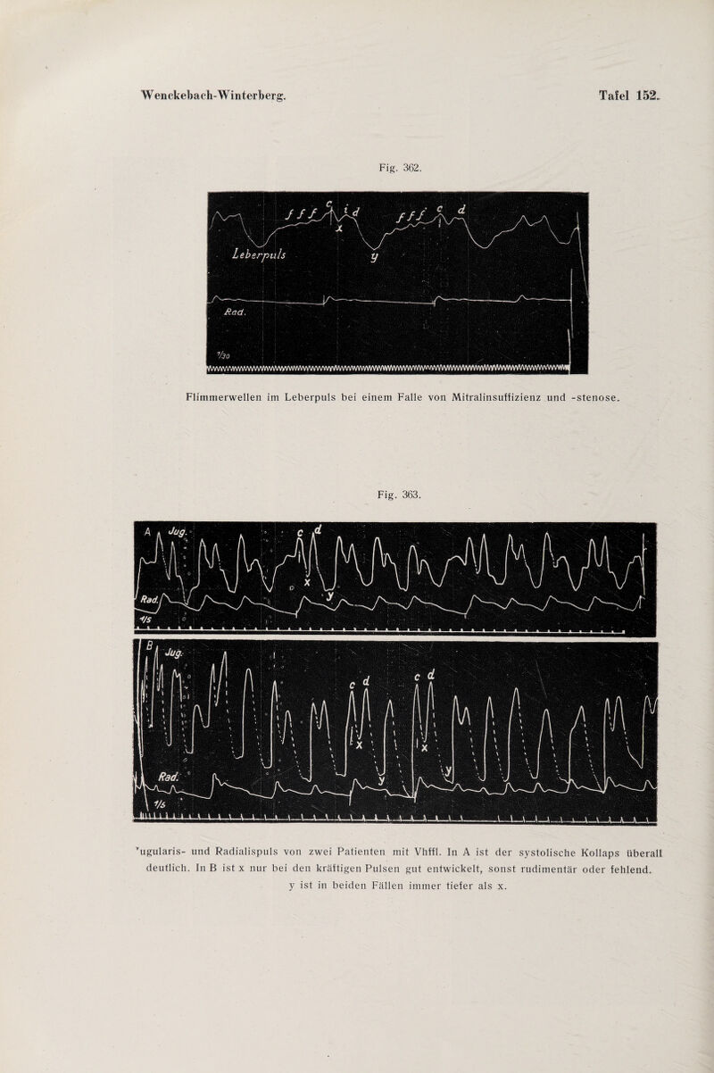 Fig. 362. Flimmerwellen im Leberpuls bei einem Falle von Mitralinsuffizienz und -Stenose. Fig. 363. ’ugularis- und Radialispuls von zwei Patienten mit Vhffl. In A ist der systolische Kollaps überall deutlich. In B ist x nur bei den kräftigen Pulsen gut entwickelt, sonst rudimentär oder fehlend. y ist in beiden Fällen immer tiefer als x.