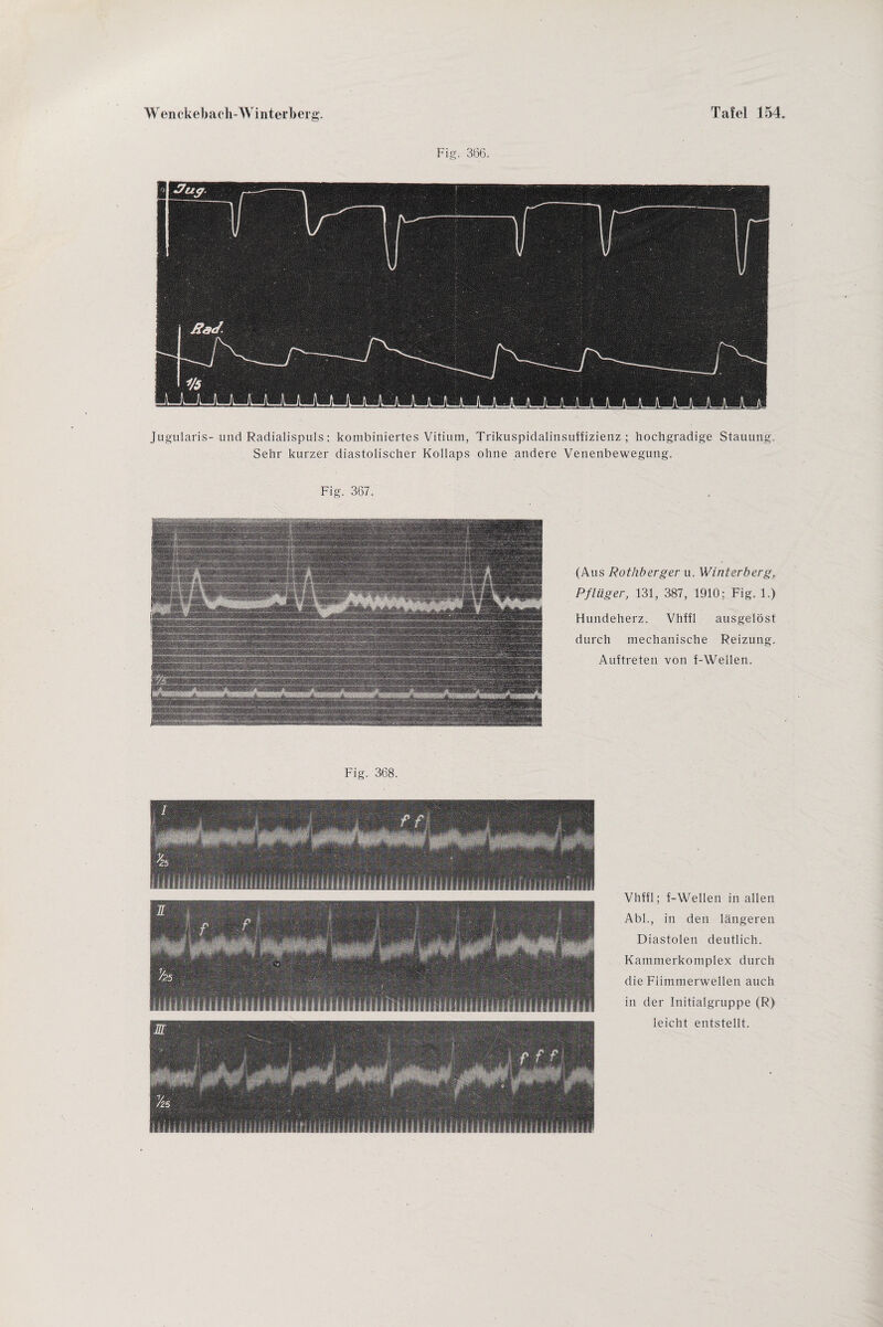 Fig. 366. Jugularis-und Radialispuls; kombiniertes Vitium, Trikuspidalinsuffizienz ; hochgradige Stauung Sehr kurzer diastolischer Kollaps ohne andere Venenbewegung. Fig. 367. (Aus Rothberger u. Winterberg, Pflüger, 131, 387, 1910: Fig. 1.) Hundeherz. Vhffl ausgelöst durch mechanische Reizung. Auftreten von f-Wellen. Fig. 368. Vhffl; f-Wellen in allen Abi., in den längeren Diastolen deutlich. Kammerkomplex durch die Flimmerwellen auch in der Initialgruppe (R) leicht entstellt.