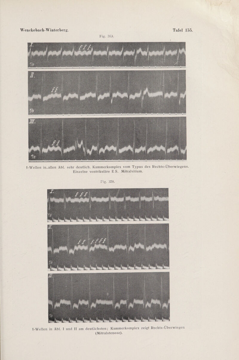 Fig. 369. f-Wellen in.allen Abi. sehr deutlich. Kammerkomplex vom Typus des Rechts-Überwiegens. Einzelne ventrikuläre E S. Mitralvitium. Fig. 370. f-Wellen in Abi. I und II am deutlichsten; Kammerkomplex zeigt Rechts-Überwiegen (Mitralstenose).