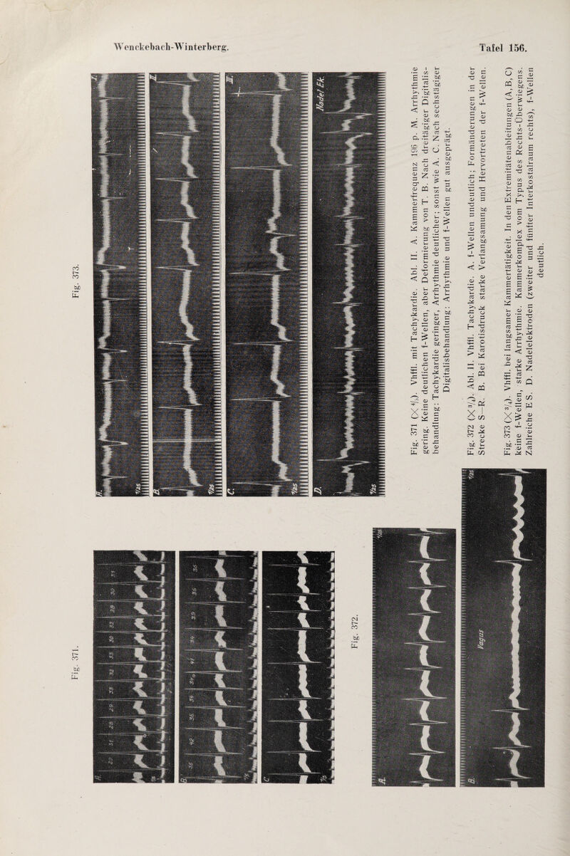 Fig. 371. Fig. 373. £ bt) 33 4— 15 *3d >> bJO < u < bJO o, .ti O) «_ y—i Ä N cj G 03 er • cu cQ OU OU CX X) 2 «3 ctf 34 s >> 0) ou ^ X , O *■+■' +3 T3 3 3 OU 3 ■c OU CU — • T* 3 C 33 5 b Ä v- V* i-. <« i-T W) 0) 3 ?3 3 au au ’S • 33 3 33 cu <+— •— 3 34 33 —: > 3 33 . -G 3 X I bjO w X J3 S ** •c 3 .5 3 bic *- .zr a> 33 au U, tx OU H- bfi 3 *- 3 £ au 3 au :ce '|- ö au 3 - . au < > . au a•> 34 33 >- b 3 «5 34 b 34 33 cu 3 s_ H T3 in cm au t— ^ CO cu bi> 3 E CD Fig. 373 (X3/4)- Vhffl. bei langsamer Kammertätigkeit. In den Extremitätenableitungen (A,B, C) keine f-Wellen, starke Arrhythmie. Kammerkomplex vom Typus des Rechts-Überwiegens. Zahlreiche ES. D. Nadelelektroden (zweiter und fünfter Interkostalraum rechts), f-Wellen deutlich.
