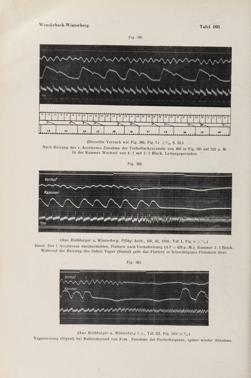 Fig. 381. (Derselbe Versuch wie Fig. 380, Fig. 7 c X2/s, S. 52.) Nach Reizung des r. Accelerans Zunahme der Vorhoftachysystolie von 460 in Fig. 380 auf 522 p. M. In der Kammer Wechsel von 4 :1 mit 2 :1 Block. Leitungsperioden. Fig. 382. •; , .■ ■ SSS ■ • ' .■ .  • . ' Vorhot (Aus Rothberger u. Winterberg, Pflüg. Arch., 160, 42, 1914; Taf. I, Fig. 6 X2/3 ) Flund. Der 1. Accelerans durchschnitten. Flattern nach Vorhofreizung (A F = 428 p. M.). Kammer 2 :1 Block. Während der Reizung des linken Vagus (Signal) geht das Flattern in feinschlägiges Flimmern über. Fig. 383. ......... .liijl.sie...li.ititm. (Aus Rothberger u. Winterberg 1. c., Taf. III, Fig. 14b X2/j-) Vagusreizung (Signal) bei Rollenabstand von 8 cm. Zunahme der Flatterfrequenz, später wieder Abnahme.