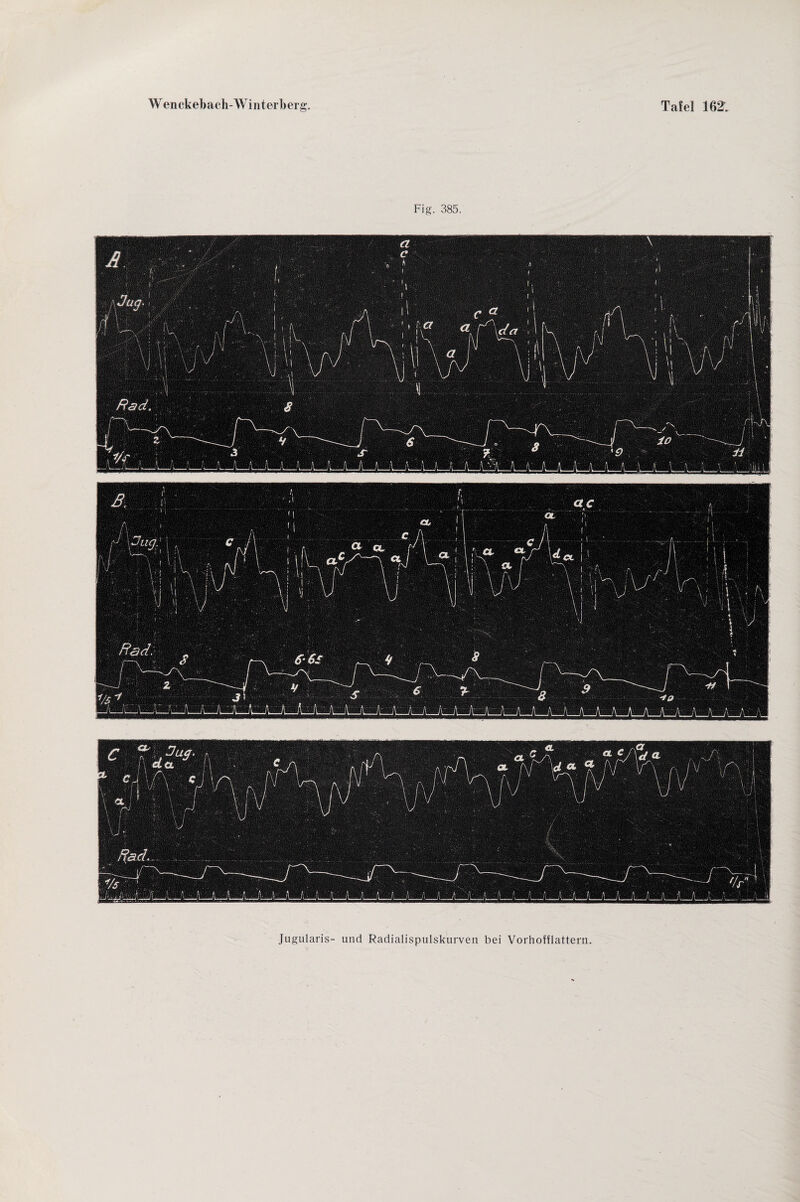 Fig. 385. Jugularis- und Radialispulskurveti bei Vorhofflattern.