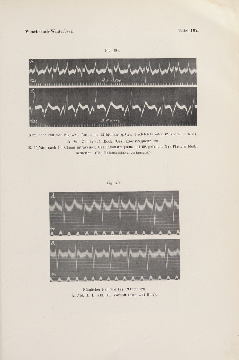 Fig. 396. Nämlicher Fall wie Fig. 395. Aufnahme 12 Monate später. Nadelelektroden (2. und 5. I K R r.). A. Vor Chinin 3:1 Block. Oszillationsfrequenz 250. B. 15 Min. nach 1,0 Chinin intravenös. Oszillationsfrequenz auf 158 gefallen. Das Flattern bleibt bestehen. (Die Polanschlüsse vertauscht.) Fig. 397. Nämlicher Fall wie Fig. 390 und 391. A. Abi. II. B. Abi. III. Vorhofflattern 2:1 Block.
