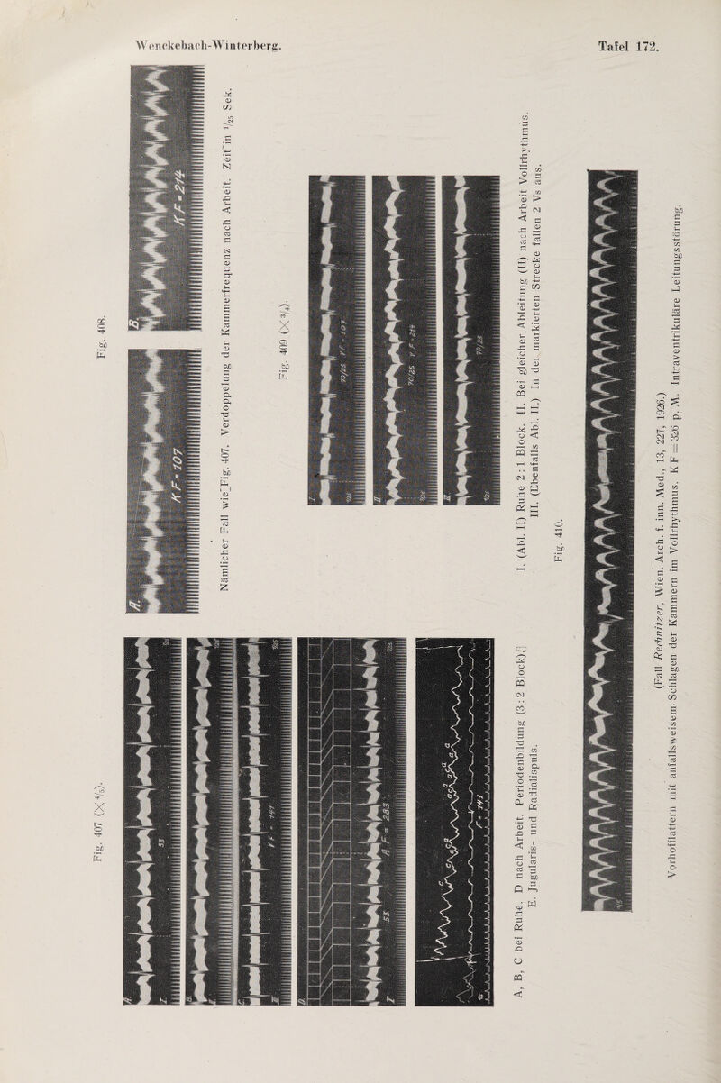Fig. 407 (X4/5). Fig. 408. a* fO ‘ bJO r—| a — C/5 § o, TJ .2 .2 75 <3 ’S ^ (X 5 i CA) ’G 3 <U Ä cö C a> W •C « •Q < (Fall Rechnitzer, Wien. Arch. f. inn. Med., 13, 227, 1926.) Vorhofflattern mit anfallsweisem. Schlagen der Kammern im Vollrhythmus. KF = 326 p. M. Intraventrikuläre Leitungsstörung.