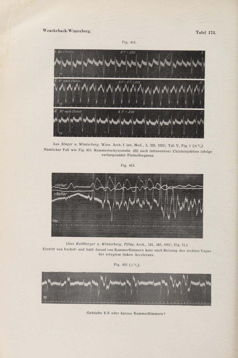 Aus Singer u. Winterberg, Wien. Arch. f. inn. Med., 3, 329, 1922; Tat. V, Fig. 1 (X2A)- Nämlicher Fall wie Fig. 413. Kammertachysystolie (B) nach intravenöser Chinininjektion infolge verlangsamter Flatterfrequenz. Fig. 415. Fig. 414. (Aus Rothberger u. Winterberg, Pflüg. Arch., 141, 343, 1911; Fig. 11.) Eintritt von Vorhof- und bald darauf von Kammerflimmern kurz nach Reizung des rechten Vagus bei erregtem linken Accelerans. Fig. 416 (X3/4). Gehäufte ES oder kurzes Kammerflimmern?