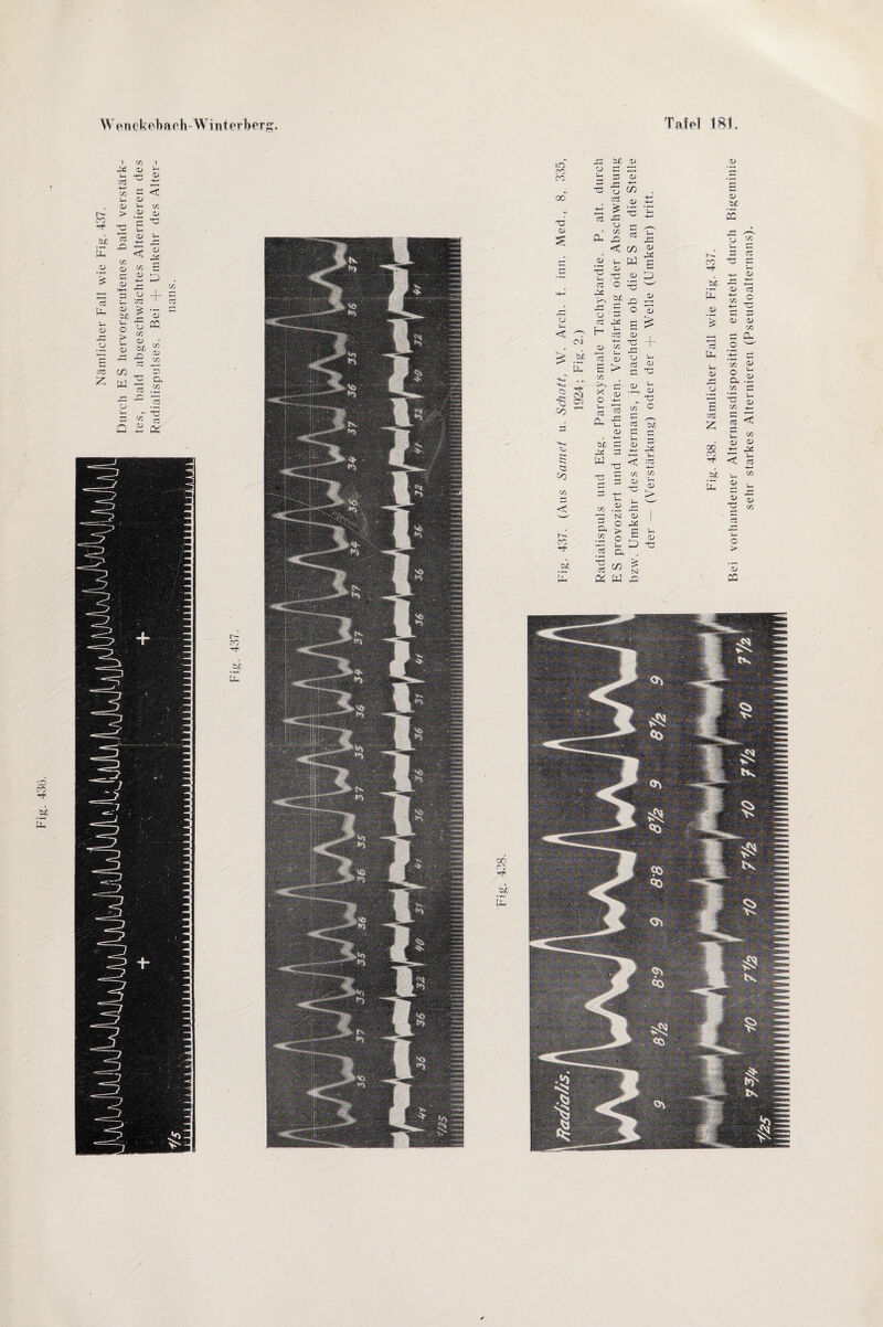 Fig. 438. Nämlicher Fall wie Fig. 437. Bei vorhandener Alternansdisposition entsteht durch Bigeminie sehr starkes Alternieren (Pseudoalternans).