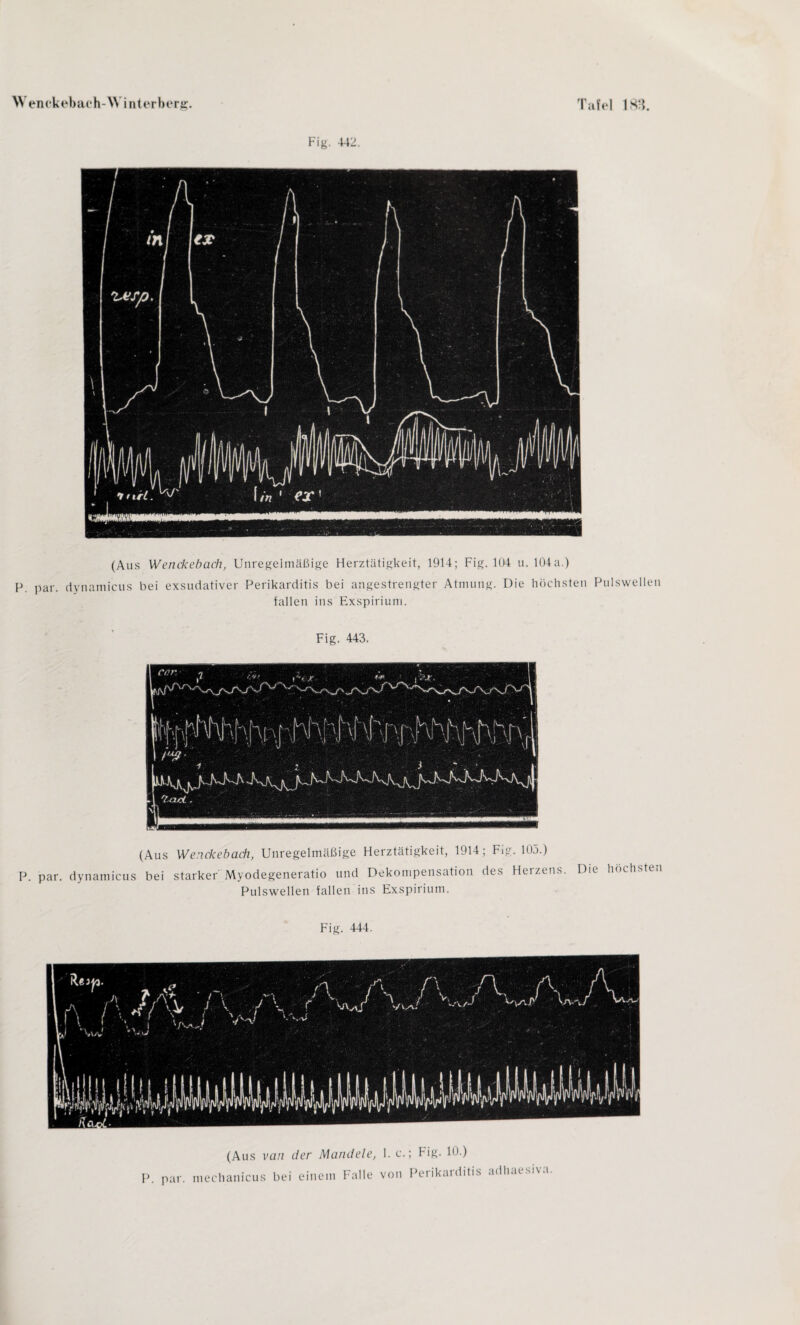 Fig. 442. (Aus Wenckebach, Unregeimäßige Herztätigkeit, 1914; Fig. 104 u. 104a.) P. par. dynamicus bei exsudativer Perikarditis bei angestrengter Atmung. Die höchsten Pulswellen fallen ins Exspirium. Fig. 443. (Aus Wenckebach, Unregelmäßige Herztätigkeit, 1914; Fig. 105.) P. par. dynamicus bei starker Myodegeneratio und Dekompensation des Heizens. Die höchste Pulswellen fallen ins Exspirium. Fig. 444. P. par. (Aus van der Mandele, 1. c. mechanicus bei einem Falle von ; Fig. 10.) Perikarditis adhaesiva.
