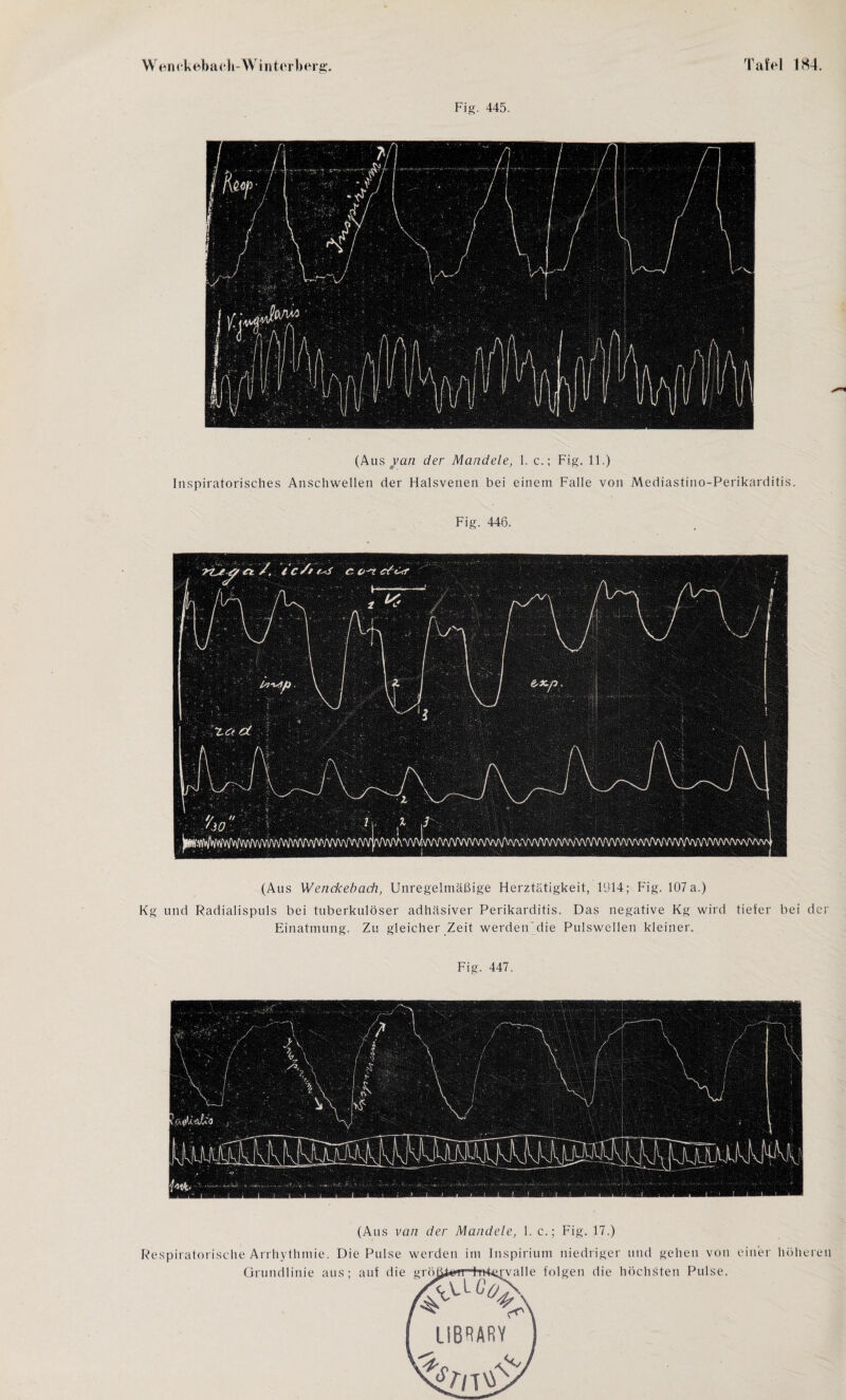 Fig. 445. (Aus yan der Mandele, 1. c.; Fig. 11.) Inspiratorisches Anschwellen der Halsvenen bei einem Falle von Mediastino-Perikarditis. Fig. 446. (Aus Wenckebach, Unregelmäßige Herztätigkeit, 1914; Fig. 107 a.) Kg und Radialispuls bei tuberkulöser adhäsiver Perikarditis. Das negative Kg wird tiefer bei der Einatmung. Zu gleicher Zeit werden die Pulswellen kleiner. Fig. 447. (Aus van der Mandele, 1. c.; Fig. 17.) Respiratorische Arrhythmie. Die Pulse werden im Inspirium niedriger und gehen von einer höheren Grundlinie aus; auf die griiß^^T^r^valle folgen die höchsten Pulse.