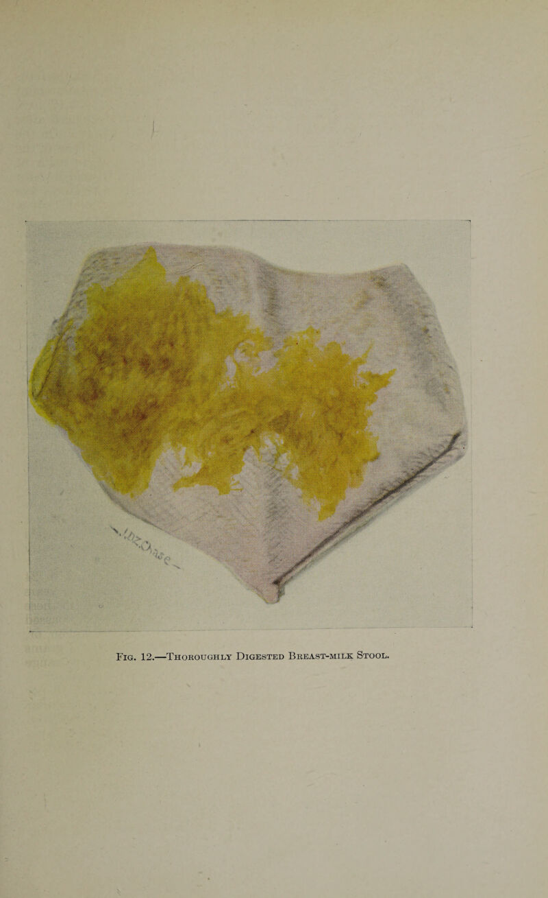 Fig. 12.—Thoroughly Digested Breast-milk Stool,
