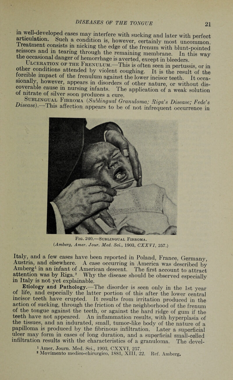 DISEASES OF THE TONGUE “J® H?vel°P?d fses interfere with sucking and later with perfect articulation. Such a condition is, however, certainly most uncommon. 3^™Pt “TtS m n!?klng fhe edge of the frenum with blunt-pointed issors and in tearing through the remaining membrane. In this way the occasional danger of hemorrhage is averted, except in bleeders. ntW CERt?0N 0F Frenulum.—1This is often seen in pertussis, or in dltl°!1S f^n'jed by violent coughing. It is the result of the forcible impact of the frenulum against the lower incisor teeth. It occa- i°na owevei, appears in disorders of other nature, or without dis- covera e cause m nursing infants. The application of a weak solution oi nitrate oi silver soon produces a cure. Sublingual Fibroma (Sublingual Granuloma; Riga’s Disease; Fede’s isease). -inis affection appears to be of not infrequent occurrence in Fig. 240.—Sublingual Fibroma. (Amberg, Amer. Jour. Med. Sci., 1903, CXXVI, 257.) Italy, and a few cases have been reported in Poland, France, Germany, Austria, and elsewhere. A case occurring in America was described by Amberg1 in an infant of American descent. The first account to attract attention was by Riga.2 Why the disease should be observed especially in Italy is not yet explainable. Etiology and Pathology.—The disorder is seen only in the 1st year of life, and especially the latter portion of this after the lower central incisor teeth have erupted. It results from irritation produced in the action of sucking, through the friction of the neighborhood of the frenum of the tongue against the teeth, or against the hard ridge of gum if the teeth have not appeared. An inflammation results, with hyperplasia of the tissues, and an indurated, small, tumor-like body of the nature of a papilloma is produced by the fibrinous infiltration. Later a superficial ulcer may form in cases of long duration, and a superficial small-celled infiltration results with the characteristics of a granuloma. The devel- 1 Amer. Journ. Med. Sci., 1903, CXXVI, 257. 2 Movimento medico-chirurgico, 1881, XIII, 22. Ref. Amberg.