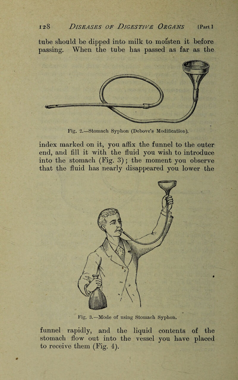 tube should be dipped into milk to moisten it before passing. When the tube has passed as far as the Fig. 2.—Stomach Syphon (Debove’s Modification). index marked on it, you affix the funnel to the outer end, and fill it with the fluid you wish to introduce into the stomach (Fig. 3); the moment you observe that the fluid has nearly disappeared you lower the Fig. 3.—Mode of using Stomach Syphon. funnel rapidly, and the liquid contents of the stomach flow out into the vessel you have placed to receive them (Fig. 4).