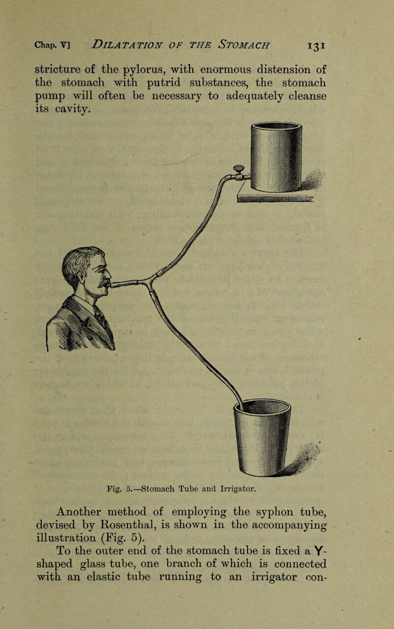 stricture of the pylorus, with enormous distension of the stomach with putrid substances, the stomach pump will often be necessary to adequately cleanse its cavity. Fig. 5.—Stomach Tube and Irrigator. Another method of employing the syphon tube, devised by Rosenthal, is shown in the accompanying illustration (Fig. 5). To the outer end of the stomach tube is fixed a Y- shaped glass tube, one branch of which is connected with an elastic tube running to an irrigator con-