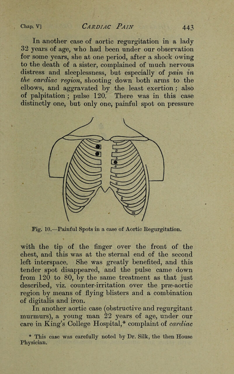 In another case of aortic regurgitation in a lady 32 years of age, who had been under our observation for some years, she at one period, after a shock owing to the death of a sister, complained of much nervous distress and sleeplessness, but especially of 'pain in the cardiac region, shooting down both arms to the elbows, and aggravated by the least exertion; also of palpitation; pulse 120. There was in this case distinctly one, but only one, painful spot on pressure Fig. 10.—Painful Spots in a case of Aortic Regurgitation. with the tip of the finger over the front of the chest, and this was at the sternal end of the second left interspace. She was greatly benefited, and this tender spot disappeared, and the pulse came down from 120 to 80, by the same treatment as that just described, viz. counter-irritation over the prae-aortic region by means of flying blisters and a combination of digitalis and iron. In another aortic case (obstructive and regurgitant murmurs), a young man 22 years of age, under our care in King’s College Hospital,* complaint of cardiac * This case was carefully noted by Dr. Silk, the then House Physician.