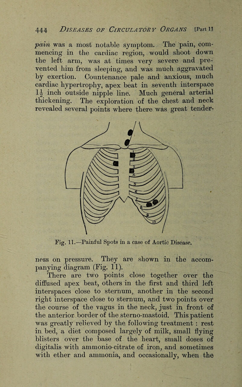 'pain was a most notable symptom. The pain, com¬ mencing in the cardiac region, would shoot down the left arm, was at times very severe and pre¬ vented him from sleeping, and was much aggravated by exertion. Countenance pale and anxious, much cardiac hypertrophy, apex beat in seventh interspace 1J inch outside nipple line. Much general arterial thickening. The exploration of the chest and neck revealed several points where there was great tender¬ ness on pressure. They are shown in the accom¬ panying diagram (Fig. 11). There are two points close together over the diffused apex beat, others in the first and third left interspaces close to sternum, another in the second right interspace close to sternum, and two points over the course of the vagus in the neck, just in front of the anterior border of the sterno-mastoid. This patient was greatly relieved by the following treatment : rest in bed, a diet composed largely of milk, small flying blisters over the base of the heart, small doses of digitalis with ammonio-citrate of iron, and sometimes with ether and ammonia, and occasionally, when the