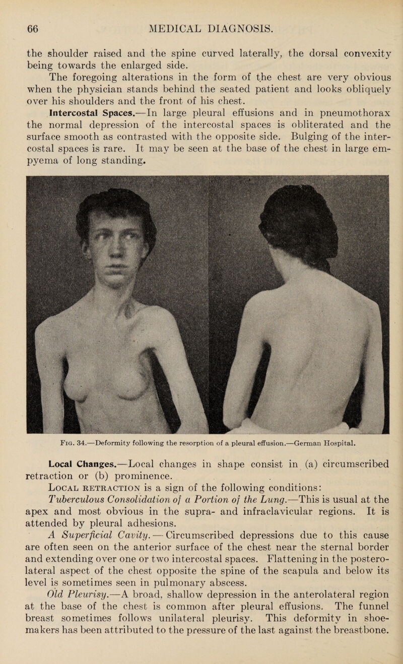 the shoulder raised and the spine curved laterally, the dorsal convexity being towards the enlarged side. The foregoing alterations in the form of the chest are very obvious when the physician stands behind the seated patient and looks obliquely over his shoulders and the front of his chest. Intercostal Spaces.—In large pleural effusions and in pneumothorax the normal depression of the intercostal spaces is obliterated and the surface smooth as contrasted with the opposite side. Bulging of the inter¬ costal spaces is rare. It may be seen at the base of the chest in large em¬ pyema of long standing. Fig. 34.—Deformity following the resorption of a pleural effusion.—German Hospital. Local Changes.—Local changes in shape consist in (a) circumscribed retraction or (b) prominence. Local retraction is a sign of the following conditions: Tuberculous Consolidation of a Portion of the Lung.—This is usual at the apex and most obvious in the supra- and infraclavicular regions. It is attended by pleural adhesions. A Superficial Cavity. — Circumscribed depressions due to this cause are often seen on the anterior surface of the chest near the sternal border and extending over one or two intercostal spaces. Flattening in the postero¬ lateral aspect of the chest opposite the spine of the scapula and below its level is sometimes seen in pulmonary abscess. Old Pleurisy.—A broad, shallow depression in the anterolateral region at the base of the chest is common after pleural effusions. The funnel breast sometimes follows unilateral pleurisy. This deformity in shoe¬ makers has been attributed to the pressure of the last against the breastbone.