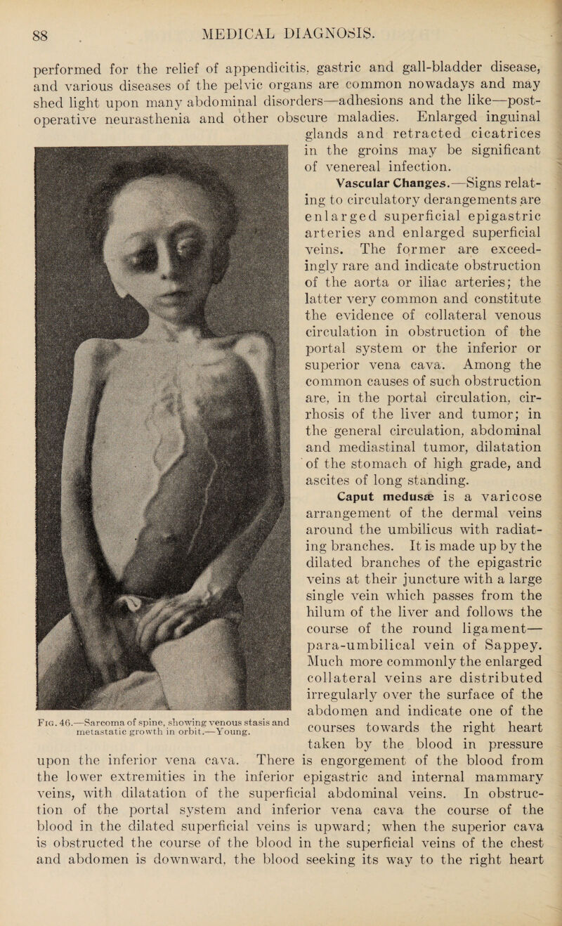 performed for the relief of appendicitis, gastric and gall-bladder disease, and various diseases of the pelvic organs are common nowadays and may shed light upon many abdominal disorders—adhesions and the like—post¬ operative neurasthenia and other obscure maladies. Enlarged inguinal glands and retracted cicatrices in the groins may be significant of venereal infection. Vascular Changes.—Signs relat¬ ing to circulatory derangements are enlarged superficial epigastric arteries and enlarged superficial veins. The former are exceed¬ ingly rare and indicate obstruction of the aorta or iliac arteries; the latter very common and constitute the evidence of collateral venous circulation in obstruction of the portal system or the inferior or superior vena cava. Among the common causes of such obstruction are, in the portal circulation, cir¬ rhosis of the liver and tumor; in the general circulation, abdominal and mediastinal tumor, dilatation of the stomach of high grade, and ascites of long standing. Caput medusas is a varicose arrangement of the dermal veins around the umbilicus with radiat¬ ing branches. It is made up by the dilated branches of the epigastric veins at their juncture with a large single vein which passes from the hilum of the liver and follows the course of the round ligament— para-umbilical vein of Sappey. Much more commonly the enlarged collateral veins are distributed irregularly over the surface of the abdomen and indicate one of the courses towards the right heart taken by the blood in pressure upon the inferior vena cava. There is engorgement of the blood from the lower extremities in the inferior epigastric and internal mammary veins, with dilatation of the superficial abdominal veins. In obstruc¬ tion of the portal system and inferior vena cava the course of the blood in the dilated superficial veins is upward; when the superior cava is obstructed the course of the blood in the superficial veins of the chest and abdomen is downward, the blood seeking its way to the right heart Fig. 46.—Sarcoma of spine, stowing venous stasis and metastatic growth in orbit.—Young.