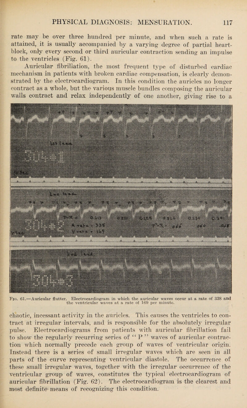 rate may be over three hundred per minute, and when such a rate is attained, it is usually accompanied by a varying degree of partial heart- block, only every second or third auricular contraction sending an impulse to the ventricles (Pig. 61). Auricular fibrillation, the most frequent type of disturbed cardiac mechanism in patients with broken cardiac compensation, is clearly demon¬ strated by the electrocardiogram. In this condition the auricles no longer contract as a whole, but the various muscle bundles composing the auricular walls contract and relax independently of one another, giving rise to a Fig. 61.—Auricular flutter. Electrocardiogram in which the auricular waves occur at a rate of 338 and the ventricular waves at a rate of 169 per minute. chaotic, incessant activity in the auricles. This causes the ventricles to con¬ tract at irregular intervals, and is responsible for the absolutely irregular pulse. Electrocardiograms from patients with auricular fibrillation fail to show the regularly recurring series of “ P ’ ’ waves of auricular contrac¬ tion which normally precede each group of waves of ventricular origin. Instead there is a series of small irregular waves which are seen in all parts of the curve representing ventricular diastole. The occurrence of these small irregular waves, together with the irregular occurrence of the ventricular group of waves, constitutes the typical electrocardiogram of auricular fibrillation (Pig. 62). The electrocardiogram is the clearest and most definite1 means of recognizing this condition.