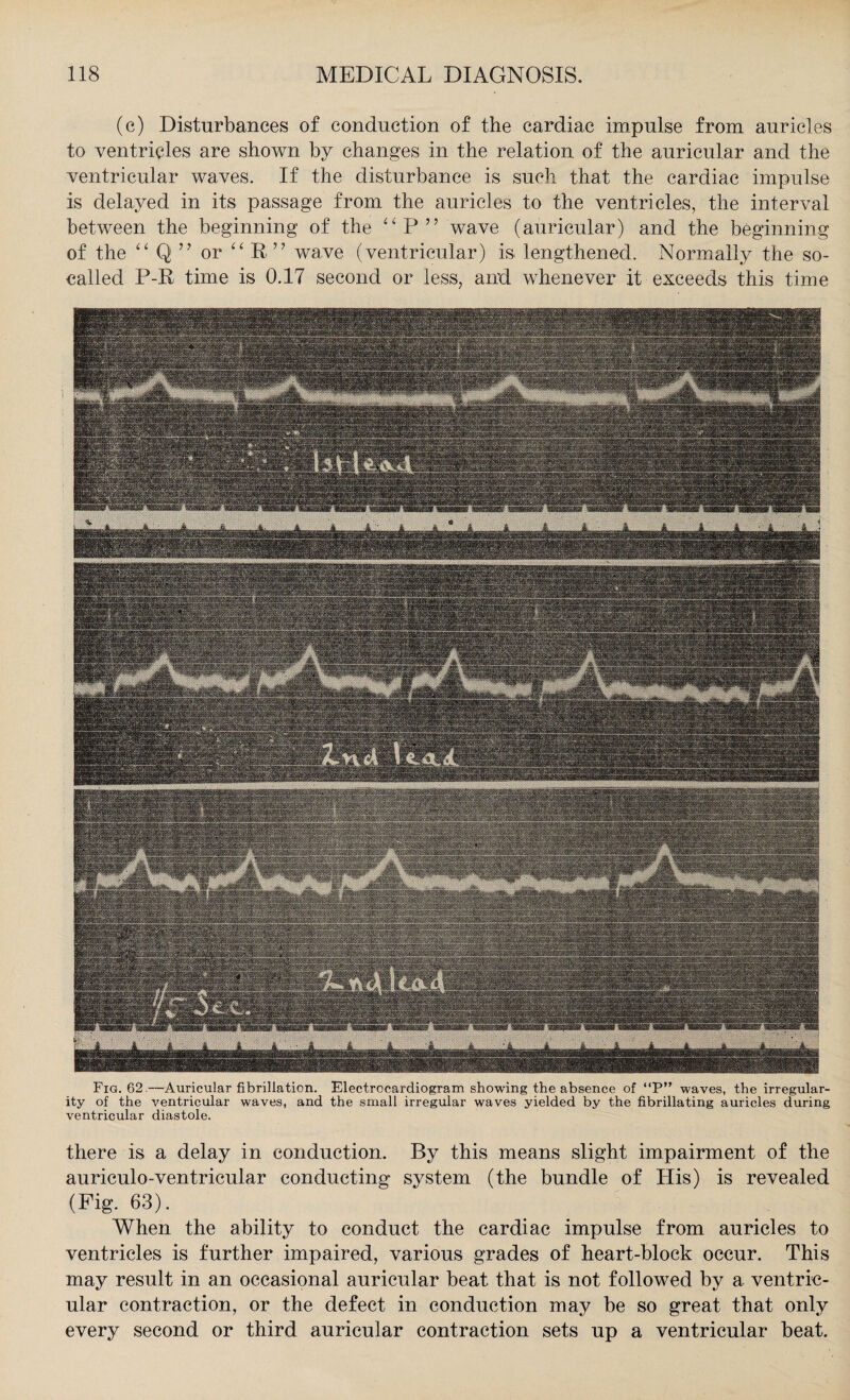 (c) Disturbances of conduction of the cardiac impulse from auricles to ventricles are shown by changes in the relation of the auricular and the ventricular waves. If the disturbance is such that the cardiac impulse is delayed in its passage from the auricles to the ventricles, the interval between the beginning of the “P” wave (auricular) and the beginning of the “ Q ” or “ R” wave (ventricular) is lengthened. Normally the so- called P-R time is 0.17 second or less, and whenever it exceeds this time yv;#vyyy y:;y ;,y •- 'S / i, -M ■ « mmm HB iiliii *;ixS«S«« V yysys. xysyyy;: ‘mm iiiiiiiwiiiil fiiiiiiiaiw v . yy ~ .-- •••••> ' ■■ ■. v..<V, v .. y \ .. - iiyiisisiyy -V, tv Xt - ..\y' , ' \ •• Fig. 62.—Auricular fibrillation. Electrocardiogram showing the absence of “P” waves, the irregular¬ ity of the ventricular waves, and the small irregular waves yielded by the fibrillating auricles during ventricular diastole. there is a delay in conduction. By this means slight impairment of the auriculo-ventricular conducting system (the bundle of His) is revealed (Fig. 63). When the ability to conduct the cardiac impulse from auricles to ventricles is further impaired, various grades of heart-block occur. This may result in an occasional auricular beat that is not followed by a ventric¬ ular contraction, or the defect in conduction may be so great that only every second or third auricular contraction sets up a ventricular beat.