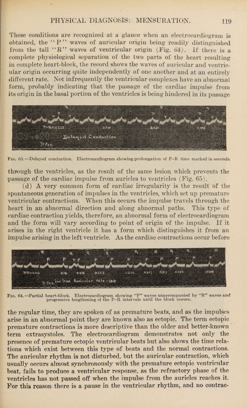 These conditions are recognized at a glance when an electrocardiogram is obtained, the “ P ’ ’ waves of auricular origin being readily distinguished from the tall “R” waves of ventricular origin (Fig. 64). If there is a complete physiological separation of the two parts of the heart resulting in complete heart-block, the record shows the waves of auricular and ventric¬ ular origin occurring quite independently of one another and at an entirely different rate. Not infrequently the ventricular complexes have an abnormal form, probably indicating that the passage of the cardiac impulse from its origin in the basal portion of the ventricles is being hindered in its passage Fig. 63.—Delayed conduction. Electrocardiogram showing prolongation of P-R time marked in seconds. through the ventricles, as the result of the same lesion which prevents the passage of the cardiac impulse from auricles to ventricles (Pig. 65). (d) A very common form of cardiac irregularity is the result of the spontaneous generation of impulses in the ventricles, which set up premature ventricular contractions. When this occurs the impulse travels through the heart in an abnormal direction and along abnormal paths. This type of cardiac contraction yields, therefore, an abnormal form of electrocardiogram and the form will vary according to point of origin of the impulse. If it arises in the right ventricle it has a form which distinguishes it from an impulse arising in the left ventricle. As, the cardiac contractions occur before Fig. 64.—Partial heart-block. Electrocardiogram showing “P” waves unaccompanied by “R” waves and progressive lengthening of the P-R intervals until the block occurs. the regular time, they are spoken of as premature beats, and as the impulses arise in an abnormal point they are known also as ectopic. The term ectopic premature contractions is more descriptive than the older and better-known term extrasystoles. The electrocardiogram demonstrates not only the presence of premature ectopic ventricular beats but also shows the time rela¬ tions which exist between this type of beats and the normal contractions. The auricular rhythm is not disturbed, but the auricular contraction, which usually occurs almost synchronously with the premature ectopic ventricular beat, fails to produce a ventricular response, as the refractory phase of the ventricles has not passed off when the impulse from the auricles reaches it. For this reason there is a pause in the ventricular rhythm, and no contrac-