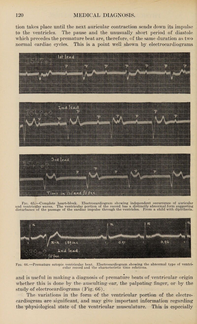 tion takes place until the next auricular contraction sends down its impulse to the ventricles. The pause and the unusually short period of diastole which precedes the premature beat are, therefore, of the same duration as two normal cardiac cycles. This is a point well shown by electrocardiograms Fig. 65.—Complete heart-block. Electrocardiogram showing independent occurrence of auricular and ventricular waves. The ventricular portion of the record has a distinctly abnormal form suggesting disturbance of the passage of the cardiac impulse through the ventricles. From a child with diphtheria. Fig. 66.—Premature ectopic ventricular beat. Electrocardiogram showing the abnormal type of ventri¬ cular record and the characteristic time relations. and is useful in making a diagnosis of premature beats of ventricular origin whether this is done by the> ausculting-ear, the palpating finger, or by the study of electrocardiograms (Fig. 66). The variations in the form of the ventricular portion of the electro¬ cardiogram are significant, and may give important information regarding the physiological state of the ventricular musculature. This is especially