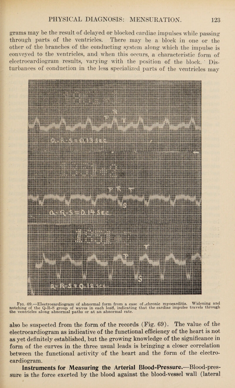 grams may be the result of delayed or blocked cardiac impulses while passing through parts of the ventricles. There may be a block in one or the other of the branches of the conducting system along which the impulse is conveyed to the ventricles, and when this occurs, a characteristic form of electrocardiogram results, varying with the position of the block. ' Dis¬ turbances of conduction in the less specialized parts of the ventricles may Fig. 69.—Electrocardiogram of abnormal form from a case of .chronic myocarditis. Widening and notching of the Q-R-S group of waves in each lead, indicating that the cardiac impulse travels through the ventricles along abnormal paths or at an abnormal rate. also be suspected from the form of the records (Pig. 69). The value of the electrocardiogram as indicative of the functional efficiency of the heart is not as yet definitely established, but the growing knowledge of the significance in form of the curves in the three usual leads is bringing a closer correlation between the functional activity of the heart and the form of the electro¬ cardiogram. Instruments for Measuring the Arterial B!ood=Pressure.—Blood-pres¬ sure is the force exerted by the blood against the blood-vessel wall (lateral