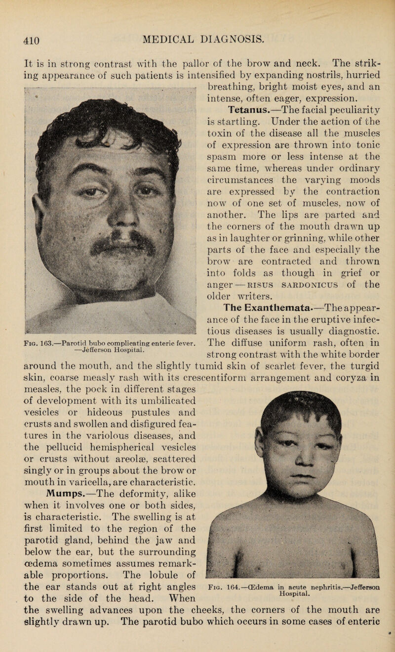 It is in strong contrast with the pallor of the brow and neck. The strik¬ ing appearance of such patients is intensified by expanding nostrils, hurried breathing, bright moist eyes, and an intense, often eager, expression. Tetanus.—The facial peculiarity is startling. Under the action of the toxin of the disease all the muscles of expression are thrown into tonic spasm more or less intense at the same time, whereas under ordinary circumstances the varying moods are expressed by the contraction now of one set of muscles, now of another. The lips are parted and the corners of the mouth drawn up as in laughter or grinning, while other parts of the face and especially the brow are contracted and thrown into folds as though in grief or anger —risus sardonicus of the older writers. The Exanthemata.—The appear¬ ance of the face in the eruptive infec¬ tious diseases is usually diagnostic. The diffuse uniform rash, often in strong contrast with the white border around the mouth, and the slightly tumid skin of scarlet fever, the turgid skin, coarse measly rash with its crescentiform arrangement and coryza in measles, the pock in different stages of development with its umbilicated vesicles or hideous pustules and crusts and swollen and disfigured fea¬ tures in the variolous diseases, and the pellucid hemispherical vesicles or crusts without areolae, scattered singly or in groups about the brow or mouth in varicella, are characteristic. Mumps.—The deformity, alike when it involves one or both sides, is characteristic. The swelling is at first limited to the region of the parotid gland, behind the jaw and below the ear, but the surrounding oedema sometimes assumes remark¬ able proportions. The lobule of the ear stands out at right angles Fig. 164.—(Edema in acute nephritis.—Jefferson to the side of the head. When Hospital. the swelling advances upon the cheeks, the corners of the mouth are slightly drawn up. The parotid bubo which occurs in some cases of enteric Fig. 163.—Parotid bubo complicating enteric fever. —Jefferson Hospital.