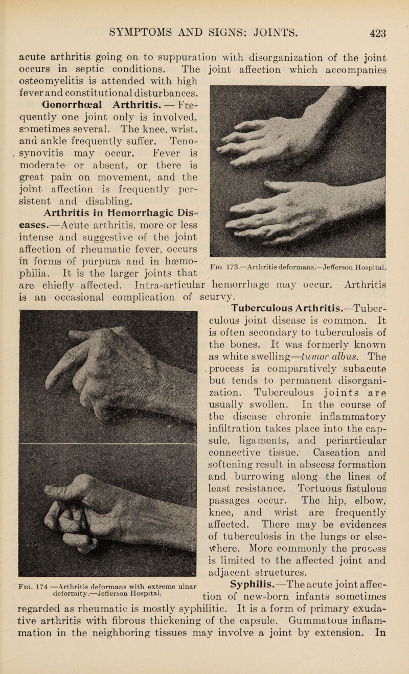 Fig 173.—Arthritis deformans.—Jefferson Hospital. acute arthritis going on to suppuration with disorganization of the joint occurs in septic conditions. The joint affection which accompanies osteomyelitis is attended wdth high fever and constitutional disturbances. Gonorrhoeal Arthritis. — Fre¬ quently one joint only is involved, sometimes several. The knee, wrist, and ankle frequently suffer. Teno¬ synovitis may occur. Fever is moderate or absent, or there is great pain on movement, and the joint affection is frequently per¬ sistent and disabling. Arthritis in Hemorrhagic Dis= eases.—Acute arthritis, more or less intense and suggestive of the joint affection of rheumatic fever, occurs in forms of purpura and in haemo¬ philia. It is the larger joints that are chiefly affected. Intra-articular hemorrhage may occur. Arthritis is an occasional complication of scurvy. Tuberculous Arthritis.—Tuber¬ culous joint disease is common. It is often secondary to tuberculosis of the bones. It was formerly known as white swelling—tumor albus. The , process is comparatively subacute but tends to permanent disorgani¬ zation. Tuberculous joints are usually swollen. In the course of the disease chronic inflammatory infiltration takes place into the cap¬ sule, ligaments, and periarticular connective tissue. Caseation and softening result in abscess formation and burrowing along the lines of least resistance. Tortuous fistulous passages occur. The hip, elbow, knee, and wrist are frequently affected. There may be evidences of tuberculosis in the lungs or else¬ where. More commonly the process is limited to the affected joint and adjacent structures. Syphilis.—The acute joint affec¬ tion of new-born infants sometimes regarded as rheumatic is mostly syphilitic. It is a form of primary exuda¬ tive arthritis with fibrous thickening of the capsule. Gummatous inflam¬ mation in the neighboring tissues may involve a joint by extension. In Fig. 174—Arthritis deformans with extreme ulnar deformity.—Jefferson Hospital.