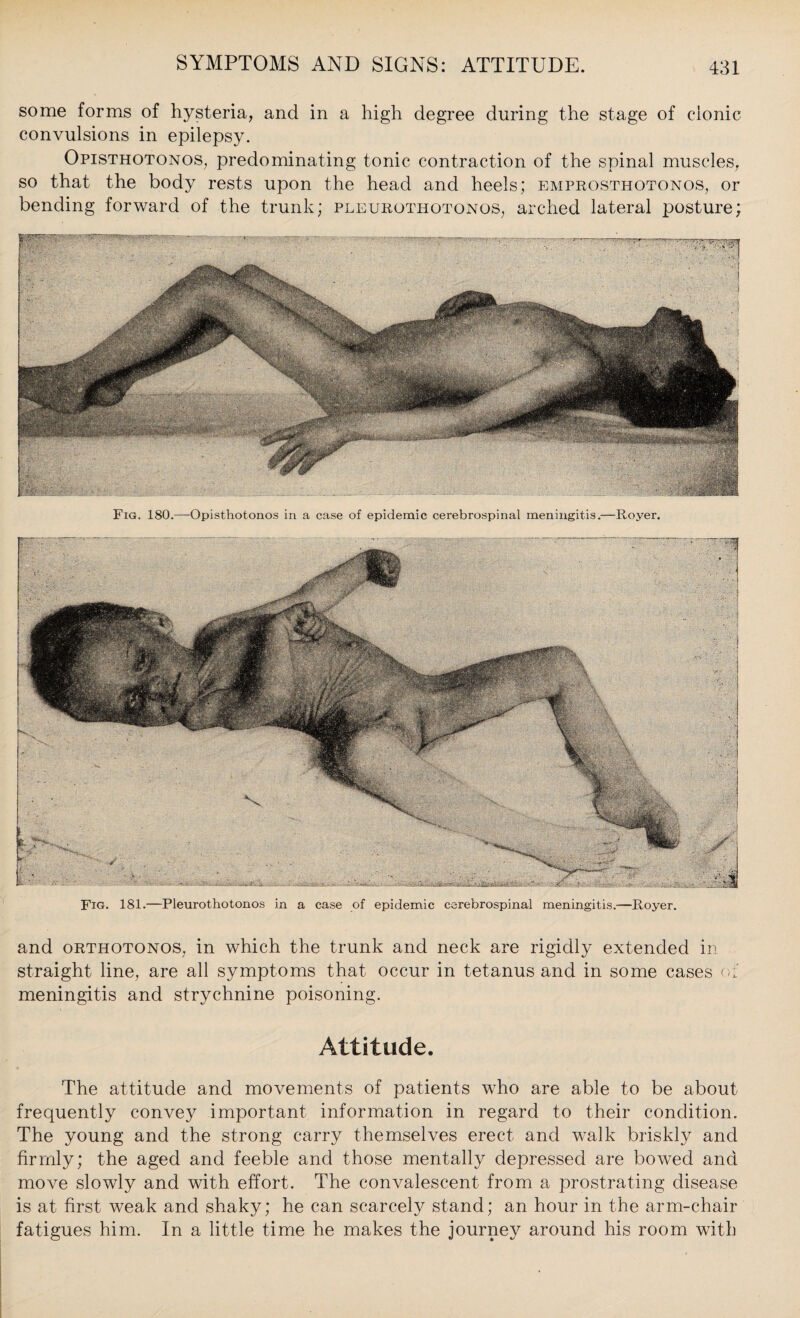 some forms of hysteria, and in a high degree during the stage of cionic convulsions in epilepsy. Opisthotonos, predominating tonic contraction of the spinal muscles, so that the body rests upon the head and heels; emprosthotonos, or bending forward of the trunk; pleurothotonos, arched lateral posture; , S'C'SC'V' Fig. 180.—Opisthotonos in a case of epidemic cerebrospinal meningitis.—Royer. and orthotonos, in which the trunk and neck are rigidly extended in straight line, are all symptoms that occur in tetanus and in some cases of meningitis and strychnine poisoning. Attitude. The attitude and movements of patients who are able to be about frequently convey important information in regard to their condition. The young and the strong carry themselves erect and walk briskly and firmly; the aged and feeble and those mentally depressed are bowed and move slowly and with effort. The convalescent from a prostrating disease is at first weak and shaky; he can scarcely stand; an hour in the arm-chair fatigues him. In a little time he makes the journey around his room with