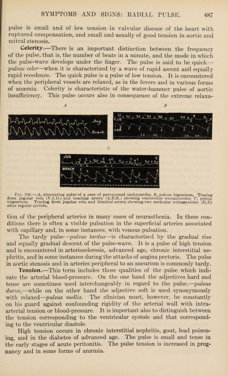 pulse is small and of low tension in valvular disease of the heart with ruptured compensation, and small and usually of good tension in aortic and mitral stenosis. Celerity.—There is an important distinction between the frequency of the pulse, that is, the number of beats in a minute, and the mode in which the pulse-wave develops under the finger. The pulse is said to be quick— pulsus celer—when it is characterized by a wave of rapid ascent and equally rapid recedence. The quick pulse is a pulse of low tension. It is encountered when the peripheral vessels are relaxed, as in the fevers and in various forms of anaemia. Celerity is characteristic of the water-hammer pulse of aortic insufficiency. This pulse occurs also in consequence of the extreme relaxa- Fig. 198.—A, alternating pulse of a case of paroxysmal tachycardia; B, pulsus bigeminus. Tracing from jugular vein (V.J.D.) and brachial artery (A.B.R.) showing ventricular extrasystoles; C, pulsus trigeminus. Tracing from jugular vein and brachial artery showing two auricular extraaystoles (E,E) after regular systole. tion of the peripheral arteries in many cases of neurasthenia. In these con¬ ditions there is often a visible pulsation in the superficial arteries associated with capillary and, in some instances, with venous pulsation. The tardy pulse—pulsus tardus—is characterized by the gradual rise and equally gradual descent of the pulse-wave. It is a pulse of high tension and is encountered in arteriosclerosis, advanced age, chronic interstitial ne¬ phritis, and in some instances during the attacks of angina pectoris. The pulse in aortic stenosis and in arteries peripheral to an aneurism is commonly tardy. Tension.—This term includes those qualities of the pulse which indi¬ cate the arterial blood-pressure. On the one hand the adjectives hard and tense are sometimes used interchangeably in regard to the pulse,—pulsus dunes,—while on the other hand the adjective soft is used synonymously with relaxed—pulsus mollis. The clinician must, however, be constantly on his guard against confounding rigidity of the arterial wall with intra¬ arterial tension or blood-pressure. It is important also to distinguish between the tension corresponding to the ventricular systole and that correspond¬ ing to the ventricular diastole. High tension occurs in chronic interstitial nephritis, gout, lead poison¬ ing, and in the diabetes of advanced age. The pulse is small and tense in the early stages of acute peritonitis. The pulse tension is increased in preg¬ nancy and in some forms of anaemia.