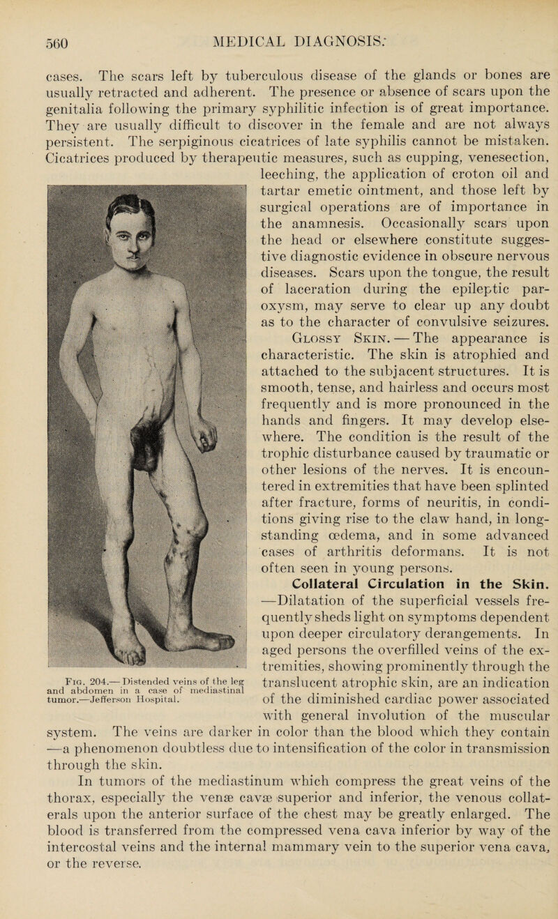 cases. The scars left by tuberculous disease of the glands or bones are usually retracted and adherent. The presence or absence of scars upon the genitalia following the primary syphilitic infection is of great importance. They are usually difficult to discover in the female and are not always persistent. The serpiginous cicatrices of late syphilis cannot be mistaken. Cicatrices produced by therapeutic measures, such as cupping, venesection, leeching, the application of croton oil and tartar emetic ointment, and those left by surgical operations are of importance in the anamnesis. Occasionally scars upon the head or elsewhere constitute sugges¬ tive diagnostic evidence in obscure nervous diseases. Scars upon the tongue, the result of laceration during the epileptic par¬ oxysm, may serve to clear up any doubt as to the character of convulsive seizures. Glossy Skin. — The appearance is characteristic. The skin is atrophied and attached to the subjacent structures. It is smooth, tense, and hairless and occurs most frequently and is more pronounced in the hands and fingers. It may develop else¬ where. The condition is the result of the trophic disturbance caused by traumatic or other lesions of the nerves. It is encoun¬ tered in extremities that have been splinted after fracture, forms of neuritis, in condi¬ tions giving rise to the claw hand, in long¬ standing oedema, and in some advanced cases of arthritis deformans. It is not often seen in young persons. Collateral Circulation in the Skin. —Dilatation of the superficial vessels fre¬ quently sheds light on symptoms dependent upon deeper circulatory derangements. In aged persons the overfilled veins of the ex¬ tremities, showing prominently through the translucent atrophic skin, are an indication of the diminished cardiac power associated with general involution of the muscular system. The veins are darker in color than the blood which they contain -—a phenomenon doubtless due to intensification of the color in transmission through the skin. In tumors of the mediastinum which compress the great veins of the thorax, especially the venae cavae superior and inferior, the venous collat¬ erals upon the anterior surface of the chest may be greatly enlarged. The blood is transferred from the compressed vena cava inferior by way of the intercostal veins and the internal mammary vein to the superior vena cava, or the reverse. Fig. 204.— Distended veins of the leg and abdomen in a case of mediastinal tumor.—Jefferson Hospital.