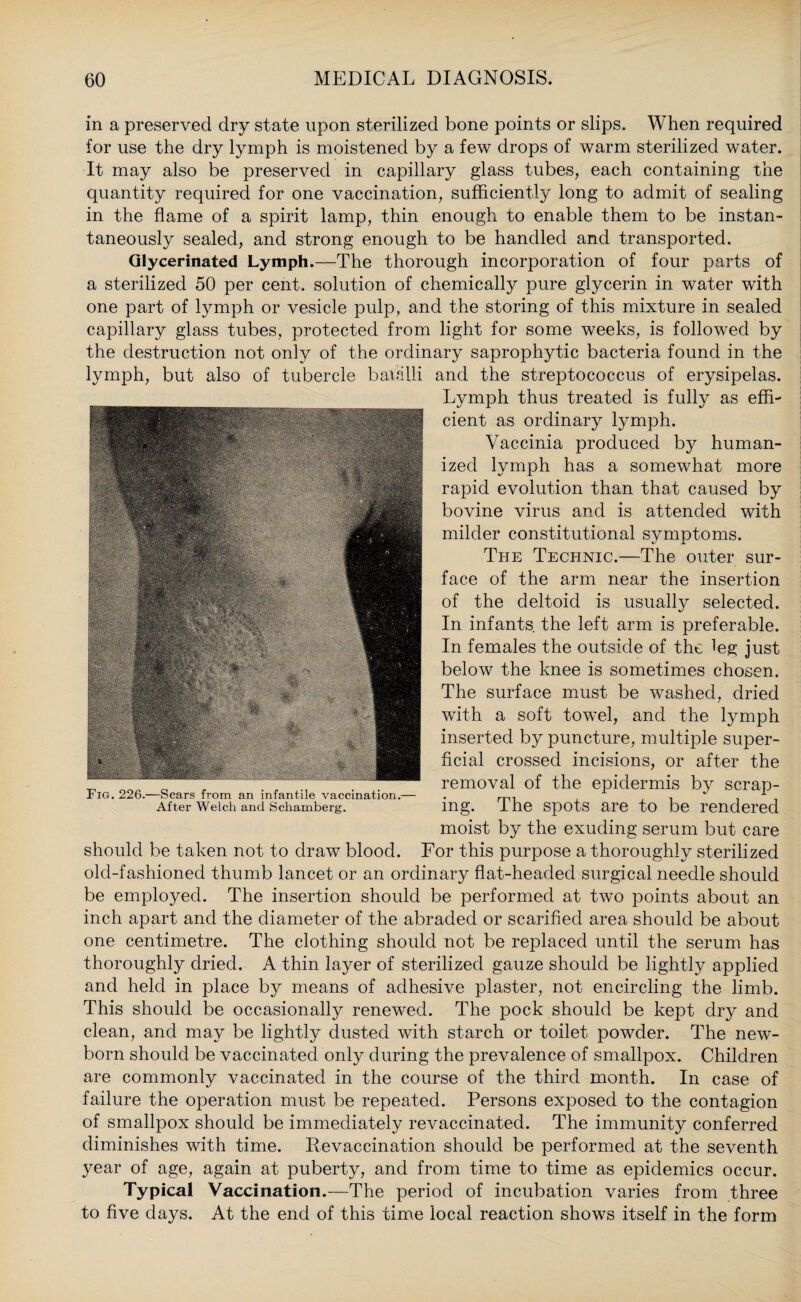 in a preserved dry state upon sterilized bone points or slips. When required for use the dry lymph is moistened by a few drops of warm sterilized water. It may also be preserved in capillary glass tubes, each containing the quantity required for one vaccination, sufficiently long to admit of sealing in the flame of a spirit lamp, thin enough to enable them to be instan¬ taneously sealed, and strong enough to be handled and transported. Glycerinated Lymph.—The thorough incorporation of four parts of a sterilized 50 per cent, solution of chemically pure glycerin in water with one part of lymph or vesicle pulp, and the storing of this mixture in sealed capillary glass tubes, protected from light for some weeks, is followed by the destruction not only of the ordinary saprophytic bacteria found in the lymph, but also of tubercle batalli and the streptococcus of erysipelas. Lymph thus treated is fully as effi¬ cient as ordinary lymph. Vaccinia produced by human¬ ized lymph has a somewhat more rapid evolution than that caused by bovine virus and is attended with milder constitutional symptoms. The Technic.—The outer sur¬ face of the arm near the insertion of the deltoid is usually selected. In infants the left arm is preferable. In females the outside of the leg just below the knee is sometimes chosen. The surface must be washed, dried with a soft towel, and the lymph inserted by puncture, multiple super¬ ficial crossed incisions, or after the removal of the epidermis by scrap¬ ing. The spots are to be rendered moist by the exuding serum but care should be taken not to draw blood. For this purpose a thoroughly sterilized old-fashioned thumb lancet or an ordinary flat-headed surgical needle should be employed. The insertion should be performed at two points about an inch apart and the diameter of the abraded or scarified area should be about one centimetre. The clothing should not be replaced until the serum has thoroughly dried. A thin layer of sterilized gauze should be lightly applied and held in place by means of adhesive plaster, not encircling the limb. This should be occasionally renewed. The pock should be kept dry and clean, and may be lightly dusted with starch or toilet powder. The new¬ born should be vaccinated only during the prevalence of smallpox. Children are commonly vaccinated in the course of the third month. In case of failure the operation must be repeated. Persons exposed to the contagion of smallpox should be immediately revaccinated. The immunity conferred diminishes with time. Revaccination should be performed at the seventh year of age, again at puberty, and from time to time as epidemics occur. Typical Vaccination.—The period of incubation varies from three to five days. At the end of this time local reaction shows itself in the form