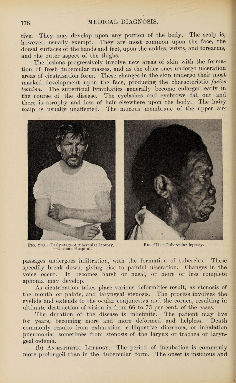 tive. They may develop upon any portion of the body. The scalp is, however, usually exempt. They are most common upon the face, the dorsal surfaces of the hands and feet, upon the ankles, wrists, and forearms, and the outer aspect of the thighs. The lesions progressively involve new areas of skin with the forma¬ tion of fresh tubercular masses, and as the older ones undergo ulceration areas of cicatrization form. These changes in the skin undergo their most marked development upon the face, producing the characteristic facies leonina. The superficial lymphatics generally become enlarged early in the course of the disease. The eyelashes and eyebrows fall out and there is atrophy and loss of hair elsewhere upon the body. The hairy scalp is usually unaffected. The mucous membrane of the upper air- Fig. 270.—Early stage of tubercular leprosy. —German Hospital. Fig. 271.—Tubercular leprosy. passages undergoes infiltration, with the formation of tubercles. These speedily break down, giving rise to painful ulceration. Changes in the voice occur. It becomes harsh or nasal, or more or less complete aphonia may develop. As cicatrization takes place various deformities result, as stenosis of the mouth or palate, and laryngeal stenosis. The process involves the eyelids and extends to the ocular conjunctiva and the cornea, resulting in ultimate destruction of vision in from 66 to 75 per cent, of the cases. The duration of the disease is indefinite. The patient may live for years, becoming more and more deformed and helpless. Death commonly results from exhaustion, colliquative diarrhoea, or inhalation pneumonia; sometimes from stenosis of the larynx or trachea or laryn¬ geal oedema. (b) Anaesthetic Leprosy.—The period of incubation is commonly more prolonged than in the tubercular form. The onset is insidious and