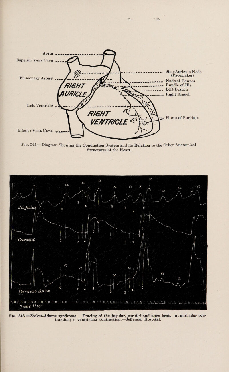 Sino-Auriculo Node (Pacemaker) Node of Tawara Bundle of His Left Branch Right Branch Fibres of Purkinje Fig. 345.—Diagram Showing the Conduction System and its Relation to the Other Anatomical Structures of the Heart. Fig. 346.—Stokes-Adams syndrome. Tracing of the Jugular, carotid and apex beat, a, auricular con¬ traction; s, ventricular contraction.—Jefferson Hospital.