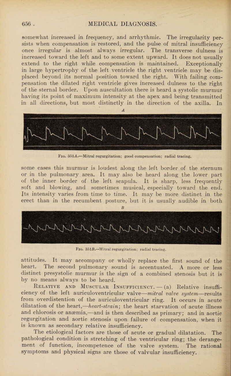 somewhat increased in frequency, and arrhythmic. The irregularity per¬ sists when compensation is restored, and the pulse of mitral insufficiency once irregular is almost always irregular. The transverse dulness is increased toward the left and to some extent upward. It does not usually extend to the right while compensation is maintained. Exceptionally in large hypertrophy of the left ventricle the right ventricle may be dis¬ placed beyond its normal position toward the right. With failing com¬ pensation the dilated right ventricle gives increased dulness to the right of the sternal border. Upon auscultation there is heard a systolic murmur having its point of maximum intensity at the apex and being transmitted in all directions, but most distinctly in the direction of the axilla. In A Fig. 351 A.—Mitral regurgitation; good compensation; radial tracing. some cases this murmur is loudest along the left border of the sternum or in the pulmonary area. It may also be heard along the lower part of the inner border of the left scapula. It is sharp, less frequently soft and blowing, and sometimes musical, especially toward the end. Jts intensity varies from time to time. It may be more distinct in the erect than in the recumbent posture, but it is usually audible in both B Fig. 3515.—Mitral regurgitation; radial tracing. attitudes. It may accompany or wholly replace the first sound of the heart. The second pulmonary sound is accentuated. A more or less distinct presystolic murmur is the sign of a combined stenosis but it is by no means always to be heard. Relative and Muscular Insufficiency. — (a) Relative insuffi¬ ciency of the left auriculoventricular valve—mitral valve system—results from overdistention of the auriculoventricular ring. It occurs in acute dilatation of the heart,—heart-strain) the heart starvation of acute illness and chlorosis or anaemia,—and is then described as primary; and in aortic regurgitation and aortic stenosis upon failure of compensation, when it is known as secondary relative insufficiency. The etiological factors are those of acute or gradual dilatation. The pathological condition is stretching of the ventricular ring; the derange¬ ment of function, incompetence of the valve system. The rational symptoms and physical signs are those of valvular insufficiency.