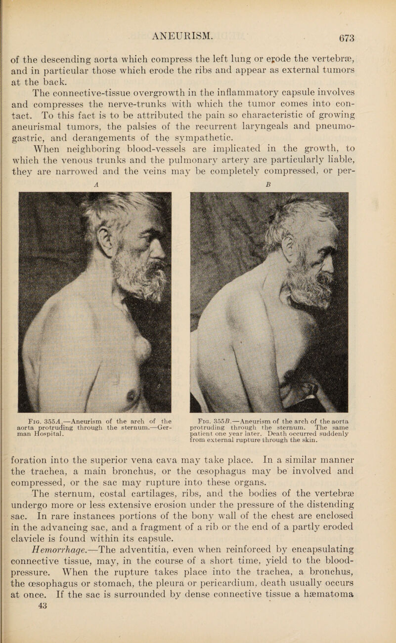 of the descending aorta which compress the left lung or epode the vertebrae, and in particular those which erode the ribs and appear as external tumors at the back. The connective-tissue overgrowth in the inflammatory capsule involves and compresses the nerve-trunks with which the tumor comes into con¬ tact. To this fact is to be attributed the pain so characteristic of growing aneurismal tumors, the palsies of the recurrent laryngeals and pneumo- gastric, and derangements of the sympathetic. When neighboring blood-vessels are implicated in the growth, to which the venous trunks and the pulmonary artery are particularly liable, they are narrowed and the veins may be completely compressed, or per- A Fig. 355A.—Aneurism of the arch of the aorta protruding through the sternum.—Ger¬ man Hospital. B Fig. 3552?.—Aneurism of the arch of the aorta protruding through the sternum. The same patient one year later. Death occurred suddenly from external rupture through the skin. foration into the superior vena cava may take place. In a similar manner the trachea, a main bronchus, or the oesophagus may be involved and compressed, or the sac may rupture into these organs. The sternum, costal cartilages, ribs, and the bodies of the vertebra? undergo more or less extensive erosion under the pressure of the distending sac. In rare instances portions of the bony wall of the chest are enclosed in the advancing sac, and a fragment of a rib or the end of a partly eroded clavicle is found within its capsule. Hemorrhage.—The adventitia, even when reinforced by encapsulating connective tissue, may, in the course of a short time, yield to the blood- pressure. When the rupture takes place into the trachea, a bronchus, the oesophagus or stomach, the pleura or pericardium, death usually occurs at once. If the sac is surrounded by dense connective tissue a hsematoma 43