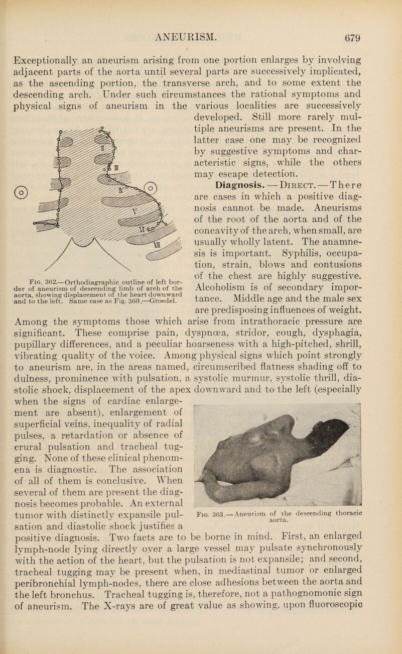 i Exceptionally an aneurism arising from one portion enlarges by involving adjacent parts of the aorta until several parts are successively implicated, as the ascending portion, the transverse arch, and to some extent the descending arch. Under such circumstances the rational symptoms and physical signs of aneurism in the various localities are successively developed. Still more rarely mul¬ tiple aneurisms are present. In the latter case one may be recognized by suggestive symptoms and char¬ acteristic signs, while the others may escape detection. Diagnosis. — Direct. — There are cases in which a positive diag¬ nosis cannot be made. Aneurisms of the root of the aorta and of the concavity of the arch, when small, are usually wholly latent. The anamne¬ sis is important. Syphilis, occupa¬ tion, strain, blows and contusions of the chest are highly suggestive. Alcoholism is of secondary impor¬ tance. Middle age and the male sex are predisposing influences of weight. Among the symptoms those which arise from intrathoracic pressure are significant. These comprise pain, dyspnoea, stridor, cough, dysphagia, pupillary differences, and a peculiar hoarseness with a high-pitched, shrill, vibrating quality of the voice. Among physical signs which point strongly to aneurism are, in the areas named, circumscribed flatness shading off to dulness, prominence with pulsation, a systolic murmur, systolic thrill, dia¬ stolic shock, displacement of the apex downward and to the left (especially when the signs of cardiac enlarge¬ ment are absent), enlargement of superficial veins, inequality of radial pulses, a retardation or absence of crural pulsation and tracheal tug¬ ging. None of these clinical phenom¬ ena is diagnostic. The association of all of them is conclusive. When several of them are present the diag¬ nosis becomes probable. An external tumor with distinctly expansile pul¬ sation and diastolic shock justifies a positive diagnosis. Two facts are to be borne in mind. First, an enlarged lymph-node lying directly over a large vessel may pulsate synchronously with the action of the heart, but the pulsation is not expansile; and second, tracheal tugging may be present when, in mediastinal tumor or enlarged peribronchial lymph-nodes, there are close adhesions between the aorta and the left bronchus. Tracheal tugging is, therefore, not a pathognomonic sign of aneurism. The X-rays are of great value as showing, upon fluoroscopic Fig. 363.— Aneurism of the descending thoracic aorta. Fig. 362.—Orthodiagraphic outline of left bor¬ der of aneurism of descending limb of arch of the aorta, showing displacement of the heart downward and to the left. Same case as Fig. 360.—Groedel.