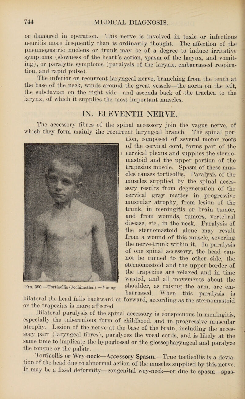 or damaged in operation. This nerve is involved in toxic or infections neuritis more frequently than is ordinarily thought. The affection of the pneumogastric nucleus or trunk may be of a degree to induce irritative symptoms (slowness of the heart’s action, spasm of the larynx, and vomit¬ ing), or paralytic symptoms (paralysis of the larynx, embarrassed respira¬ tion, and rapid pulse). The inferior or recurrent laryngeal nerve, branching from the tenth at the base of the neck, winds around the great vessels—the aorta on the left, the subclavian on the right side—and ascends back of -the trachea to the larynx, of which it supplies the most important muscles. IX. ELEVENTH NERVE. The accessory fibres of the spinal accessory join the vagus nerve, of which they form mainly the recurrent laryngeal branch. The spinal por¬ tion, composed of several motor roots of the cervical cord, forms part of the ( cervical plexus and supplies the sterno- mastoid and the upper portion of the trapezius muscle. Spasm of these mus¬ cles causes torticollis. Paralysis of the muscles supplied by the spinal acces¬ sory results from degeneration of the cervical gray matter in progressive muscular atrophy, from lesion of the trunk, in meningitis or brain tumor, and from wounds, tumors, vertebral disease, etc., in the neck. Paralysis of the sternomastoid alone may result from a wound of this muscle, severing the nerve-trunk within it. In paralysis of one spinal accessory, the head can¬ not be turned to the other side, the sternomastoid and the upper border of the trapezius are relaxed and in time wasted, and all movements about the shoulder, as raising the arm, are em¬ barrassed. When this paralysis is bilateral the head falls backward or forward, according as the sternomastoid or the trapezius is more affected. Bilateral paralysis of the spinal accessory is conspicuous in meningitis, especially the tuberculous form of childhood, and in progressive muscular atrophy. Lesion of the nerve at the base of the brain, including the acces¬ sory part (laryngeal fibres), paralyzes the vocal cords, and is likely at the same time to implicate the hypoglossal or the glossopharyngeal and paralyze the tongue or the palate. lorticollis or Wry=neck—Accessory Spasm.—True torticollis is a devia¬ tion of the head due to abnormal action of the muscles supplied by this nerve. It may be a fixed deformity—congenital wry-neck—or due to spasm—spas- Fig. 390.—Torticollis (Joeliimsthal).—Young.