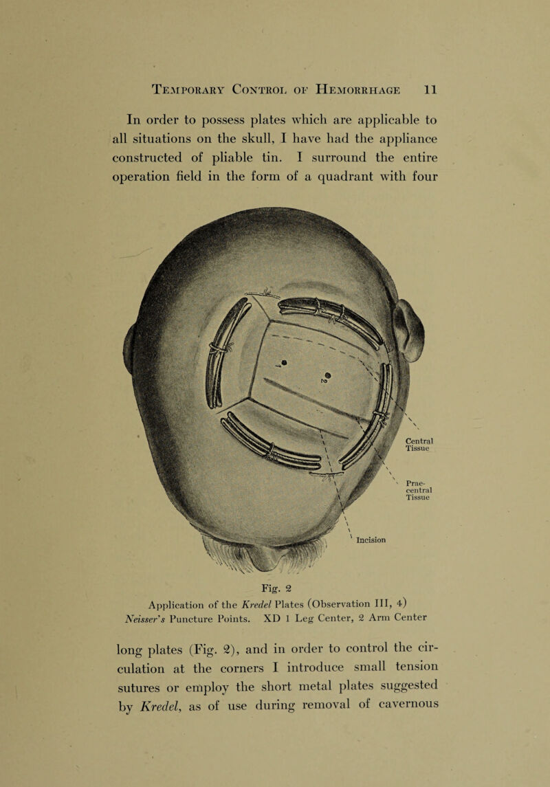 In order to possess plates which are applicable to all situations on the skull, I have had the appliance constructed of pliable tin. I surround the entire operation field in the form of a quadrant with four Fig. 2 Application of the Kredel Plates (Observation III, 4) Neisser's Puncture Points. XD 1 Leg Center, 2 Arm Center long plates (Fig. 2), and in order to control the cir¬ culation at the corners I introduce small tension sutures or employ the short metal plates suggested by Kredel, as of use during removal of cavernous